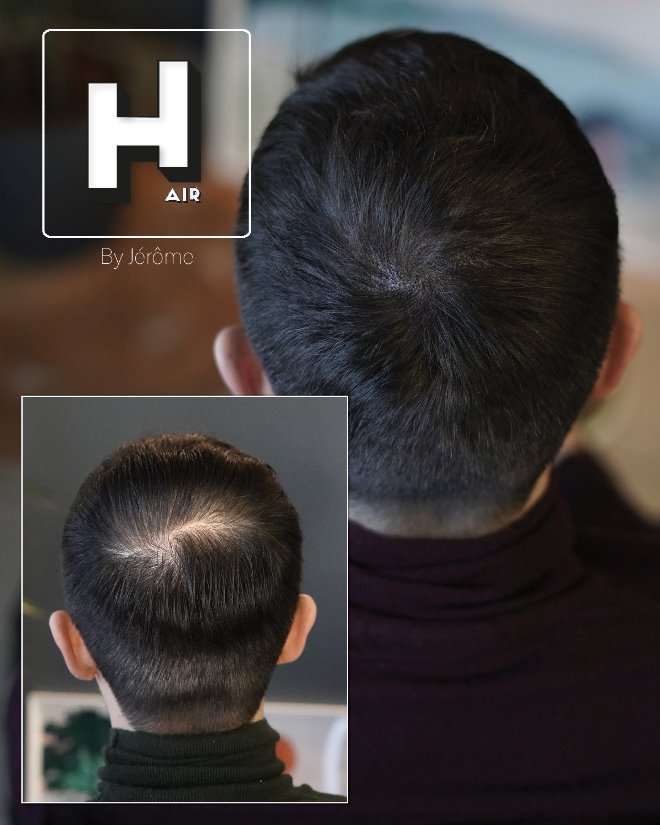 greffes cheveux turquie 4.jpg