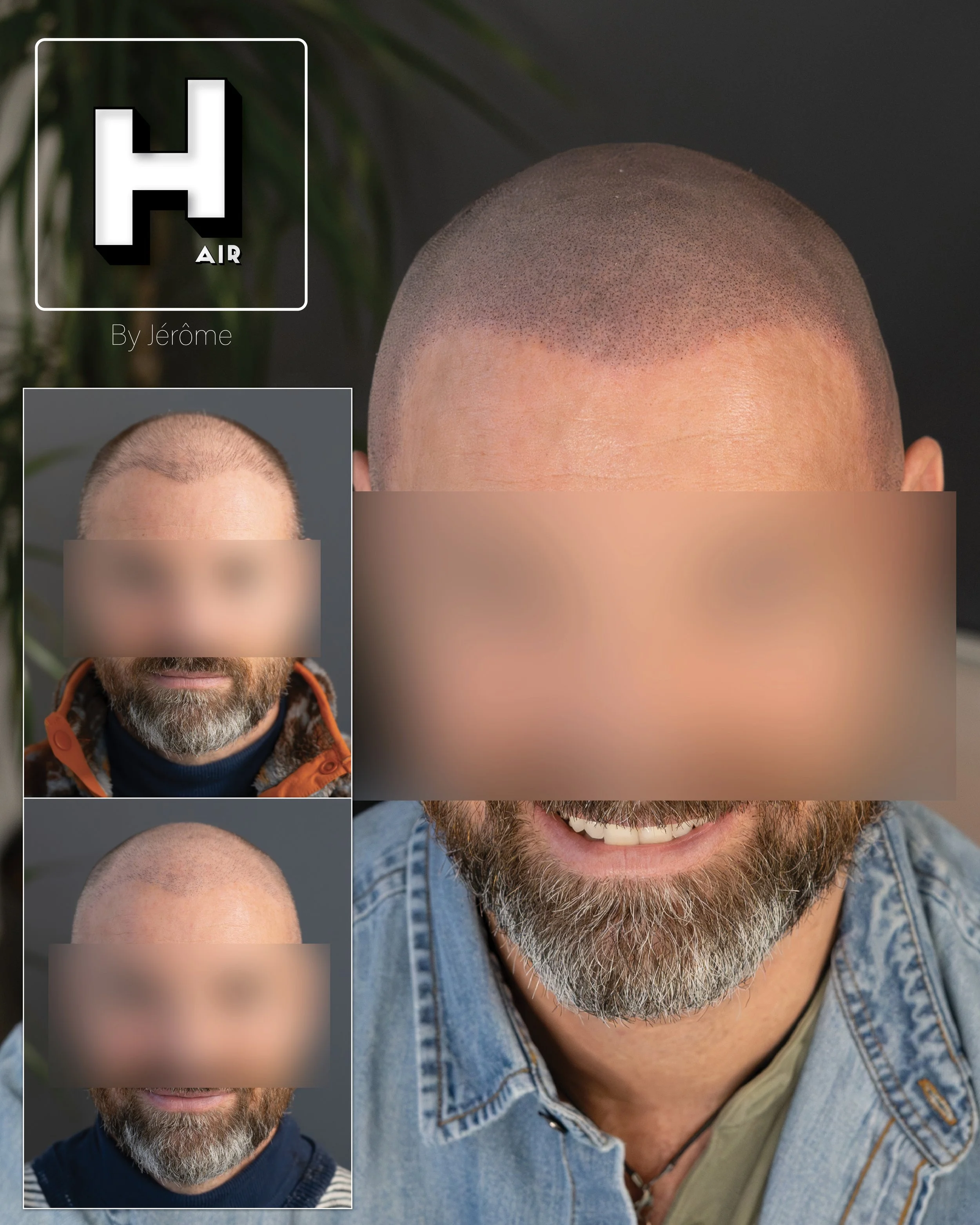 smp  effet rasé greffe cheveux turquie fue smpartistbelgium hairbyjerome.jpg