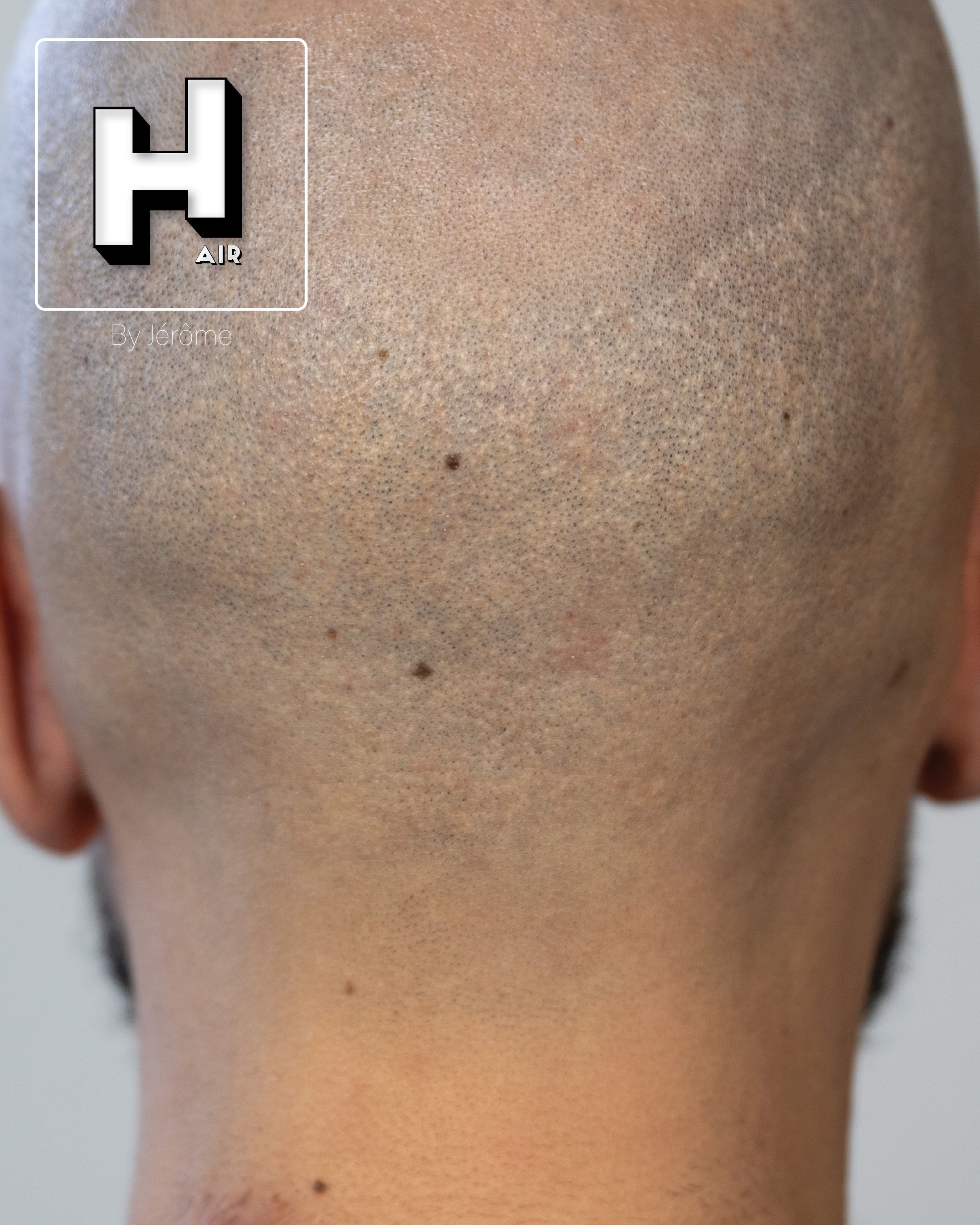 camouflage cicatrice greffe turquie hair by jerome namur luxembourg4.jpg