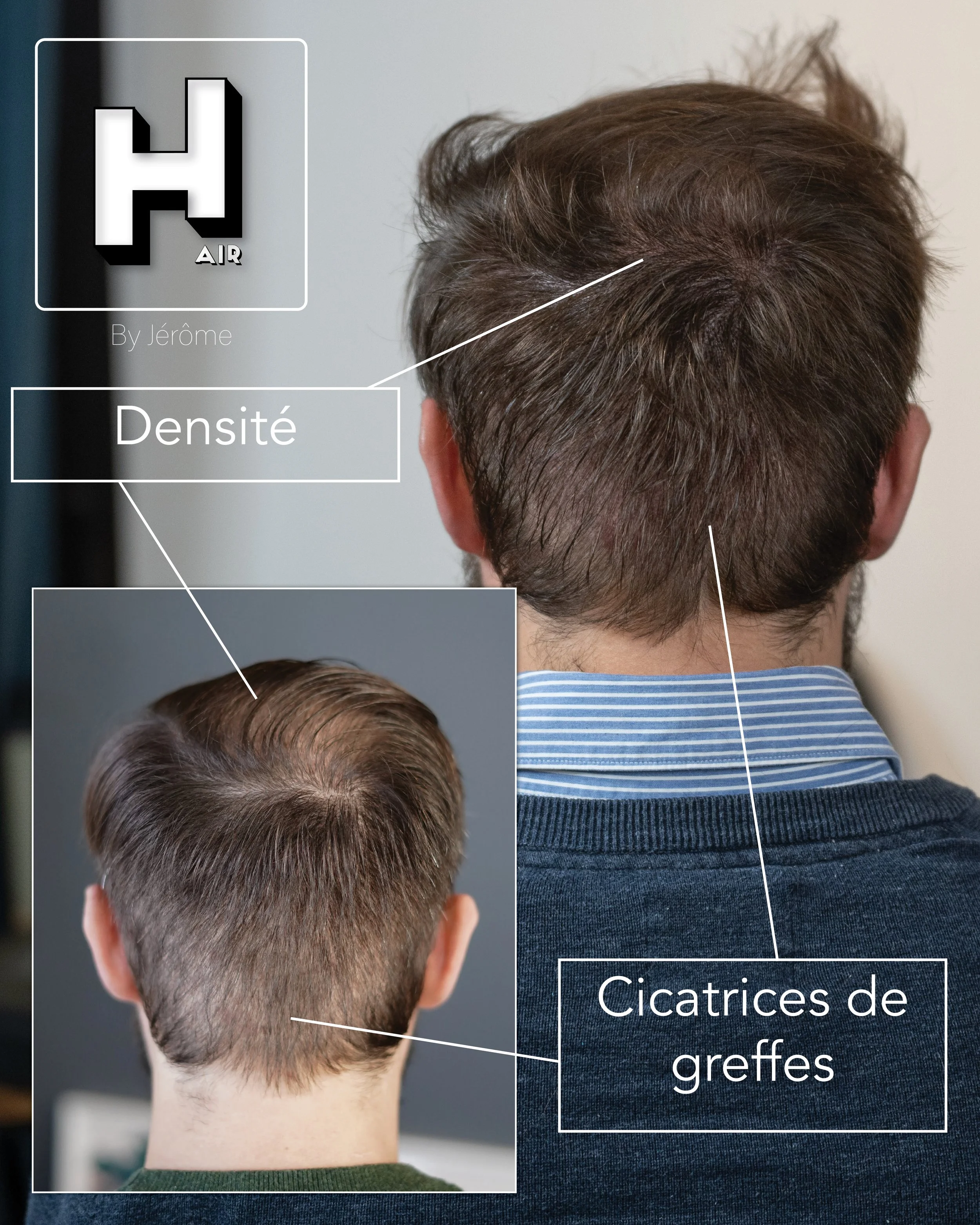 camouflage de cicatrice et densité hair by jerome.jpg