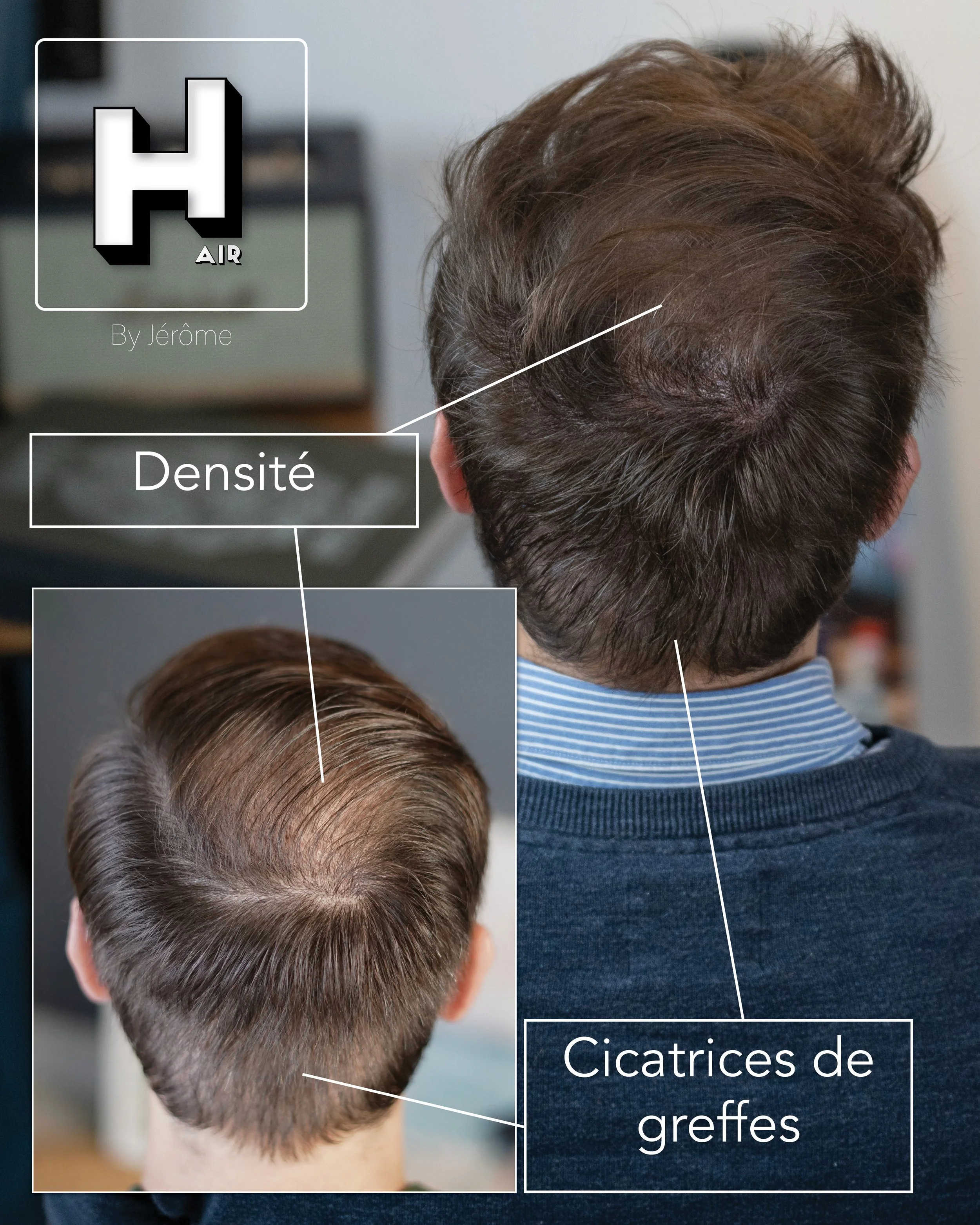 camouflage de cicatrice et densité hair by jerome2.jpg