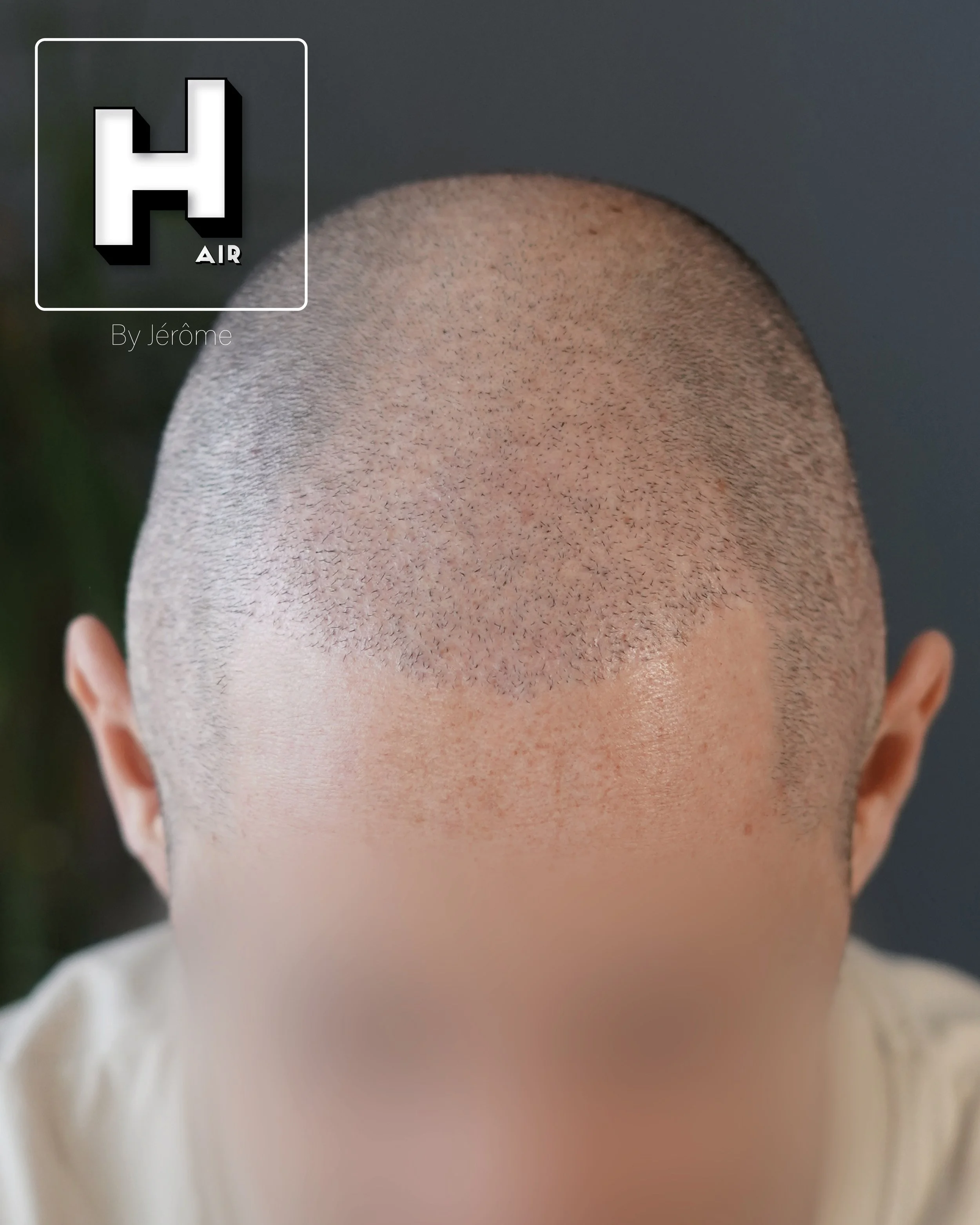 Densité après greffe turquie hair by jérôme2.jpg