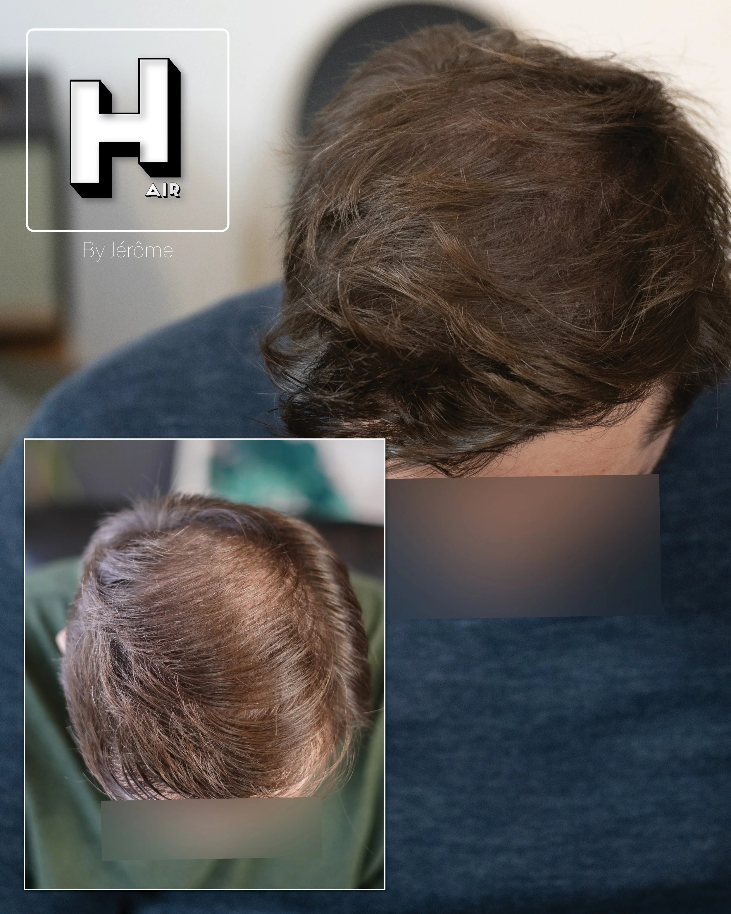 camouflage de cicatrice et densité hair by jerome4.jpg