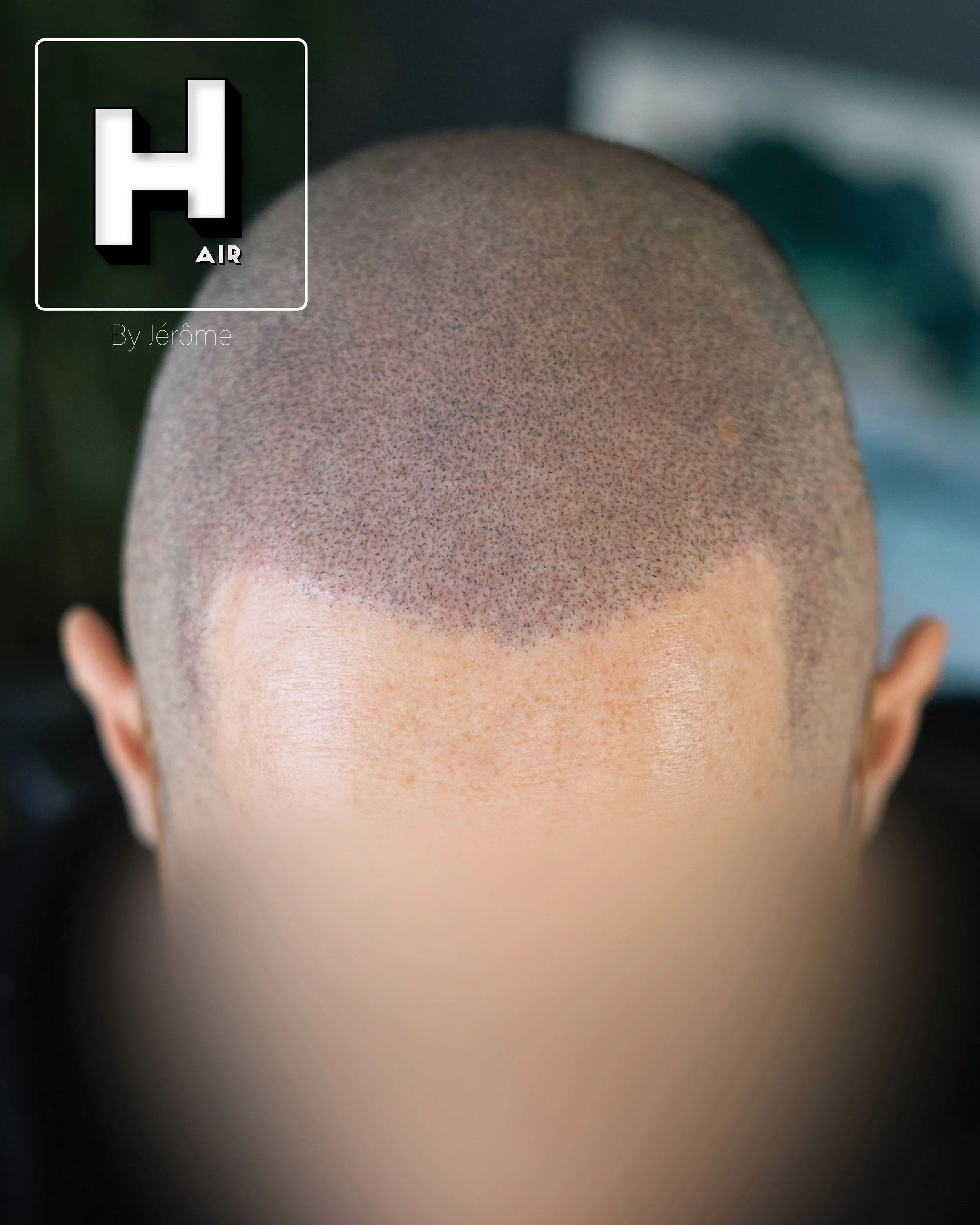 Densité après greffe turquie hair by jérôme3.jpg
