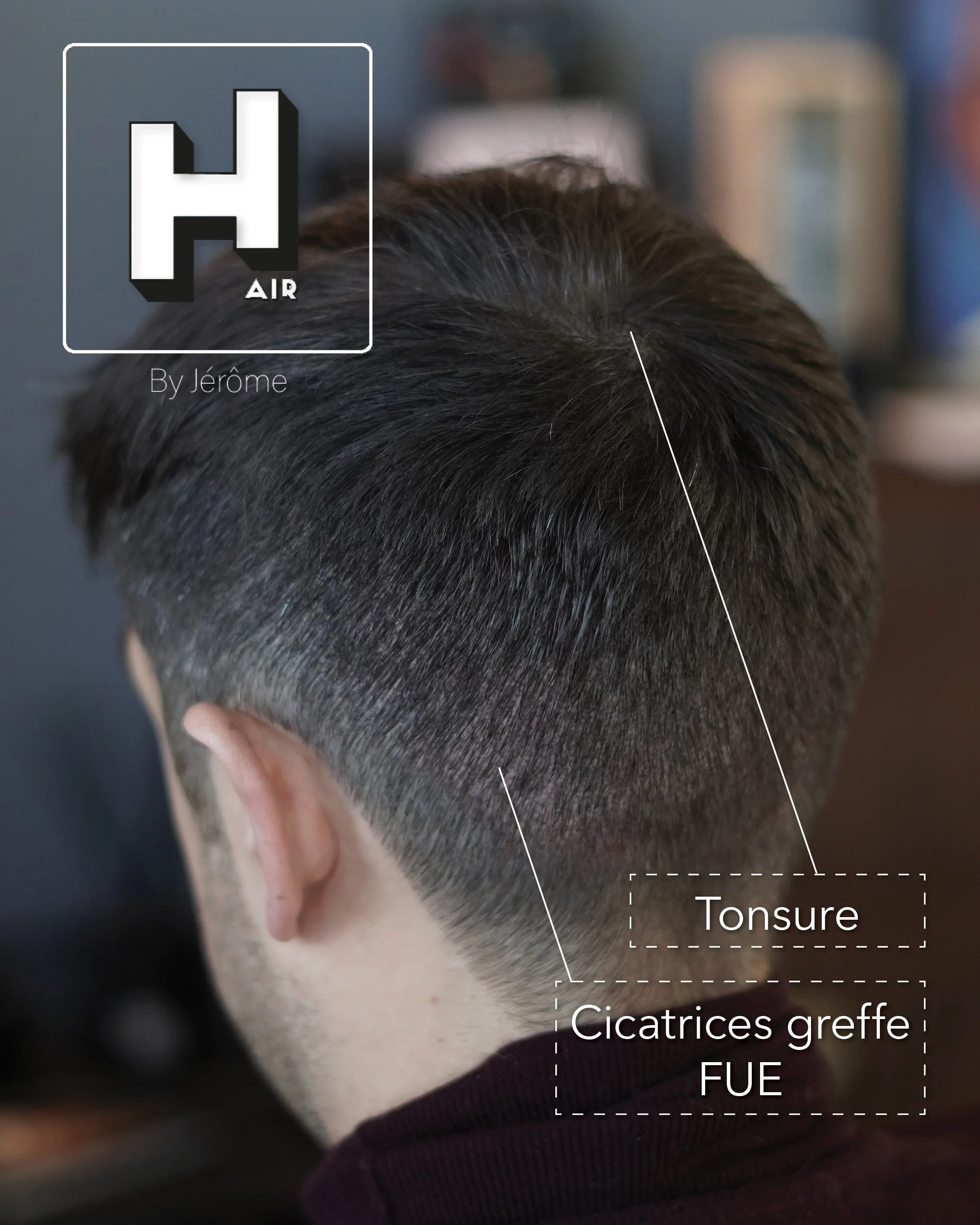 greffes cheveux turquie 2.jpg