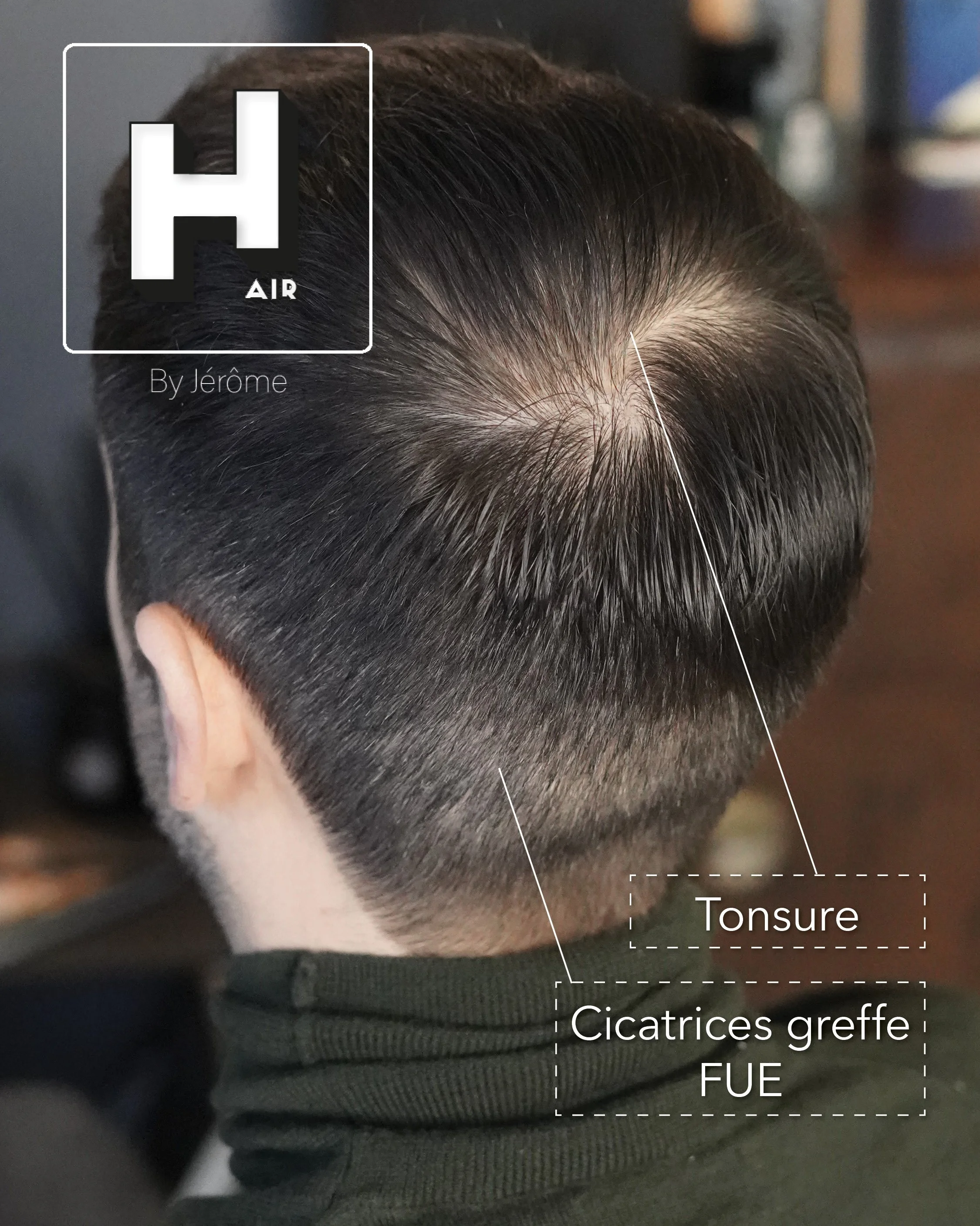 greffes cheveux turquie 3.jpg