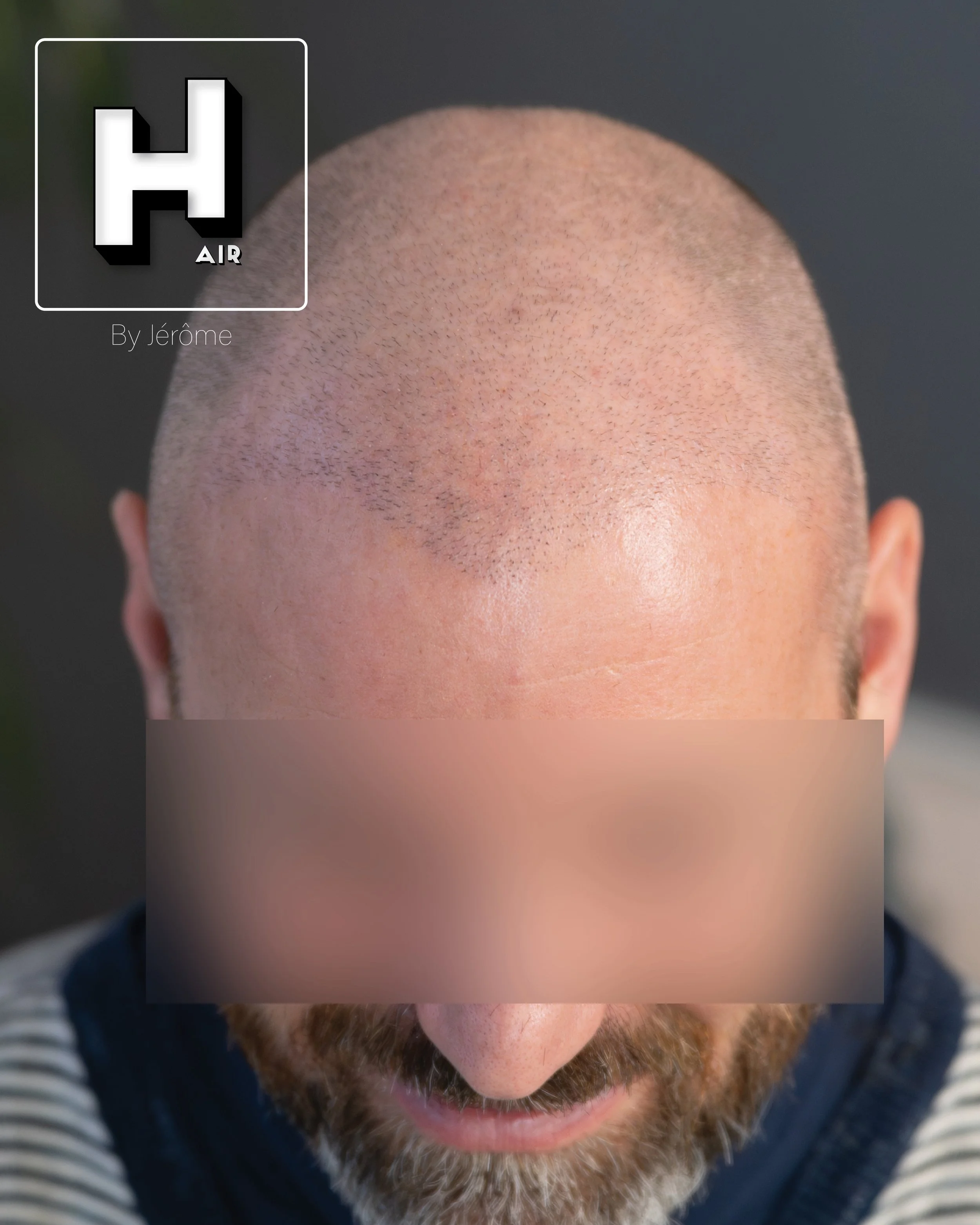 smp  effet rasé greffe cheveux turquie fue smpartistbelgium hairbyjerome7.jpg