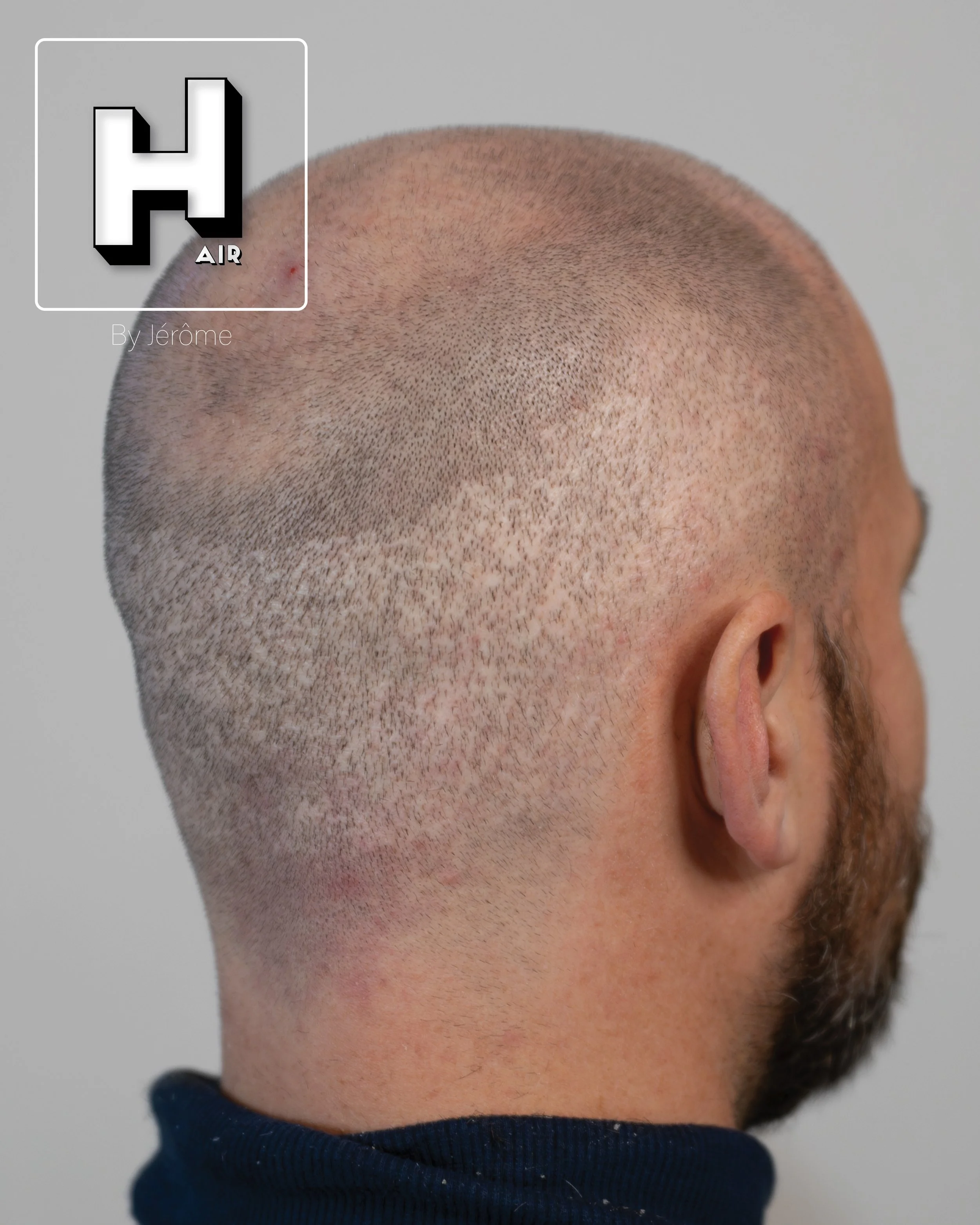 smp  effet rasé greffe cheveux turquie fue smpartistbelgium hairbyjerome23.jpg