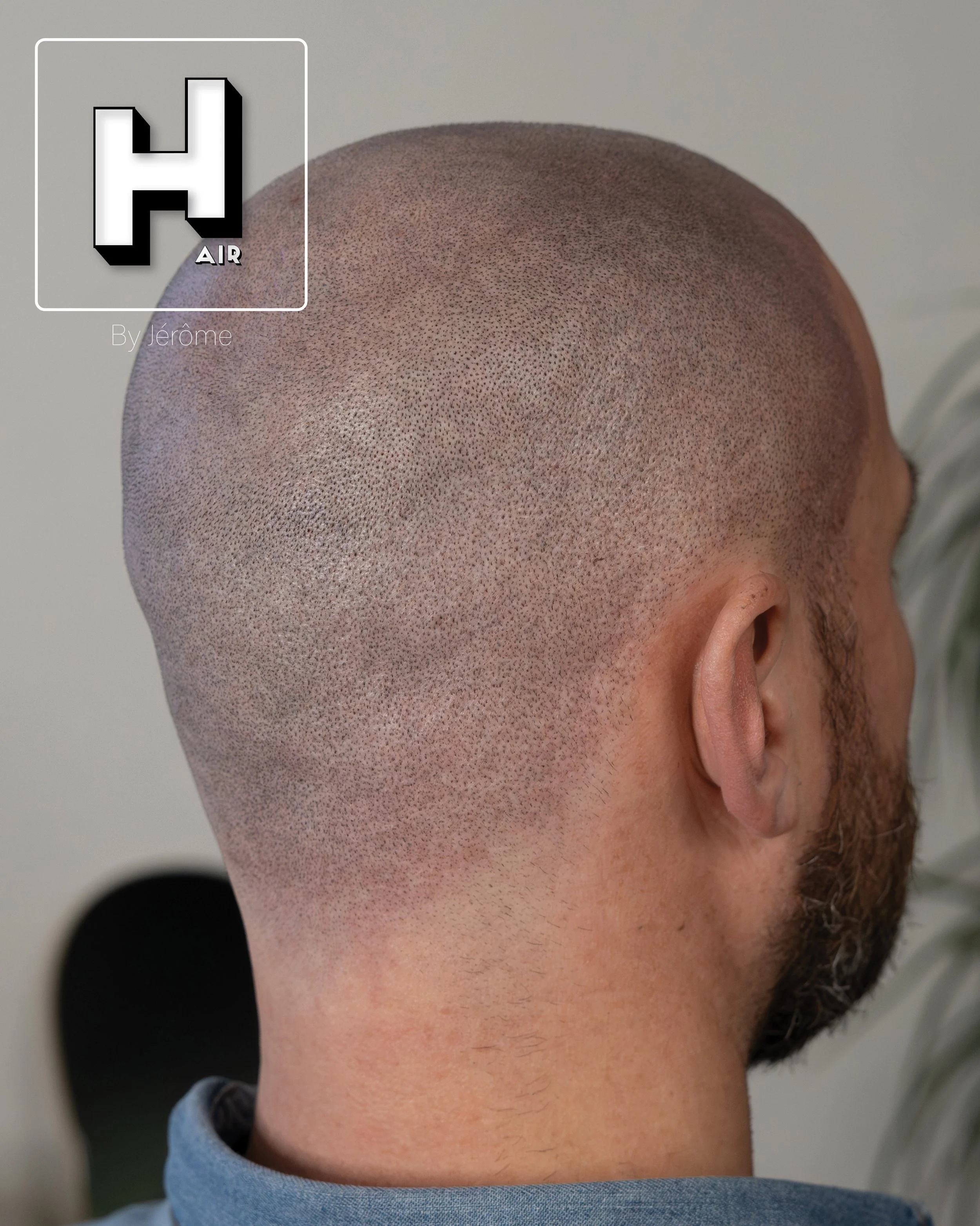 smp  effet rasé greffe cheveux turquie fue smpartistbelgium hairbyjerome24.jpg