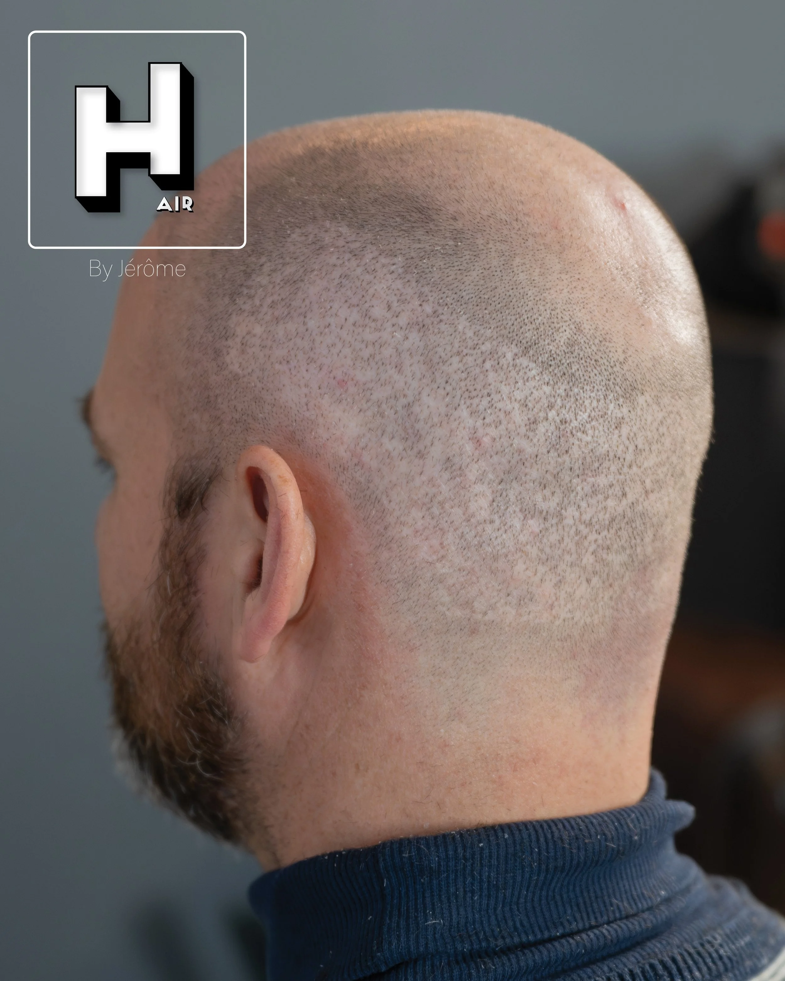 smp  effet rasé greffe cheveux turquie fue smpartistbelgium hairbyjerome27.jpg