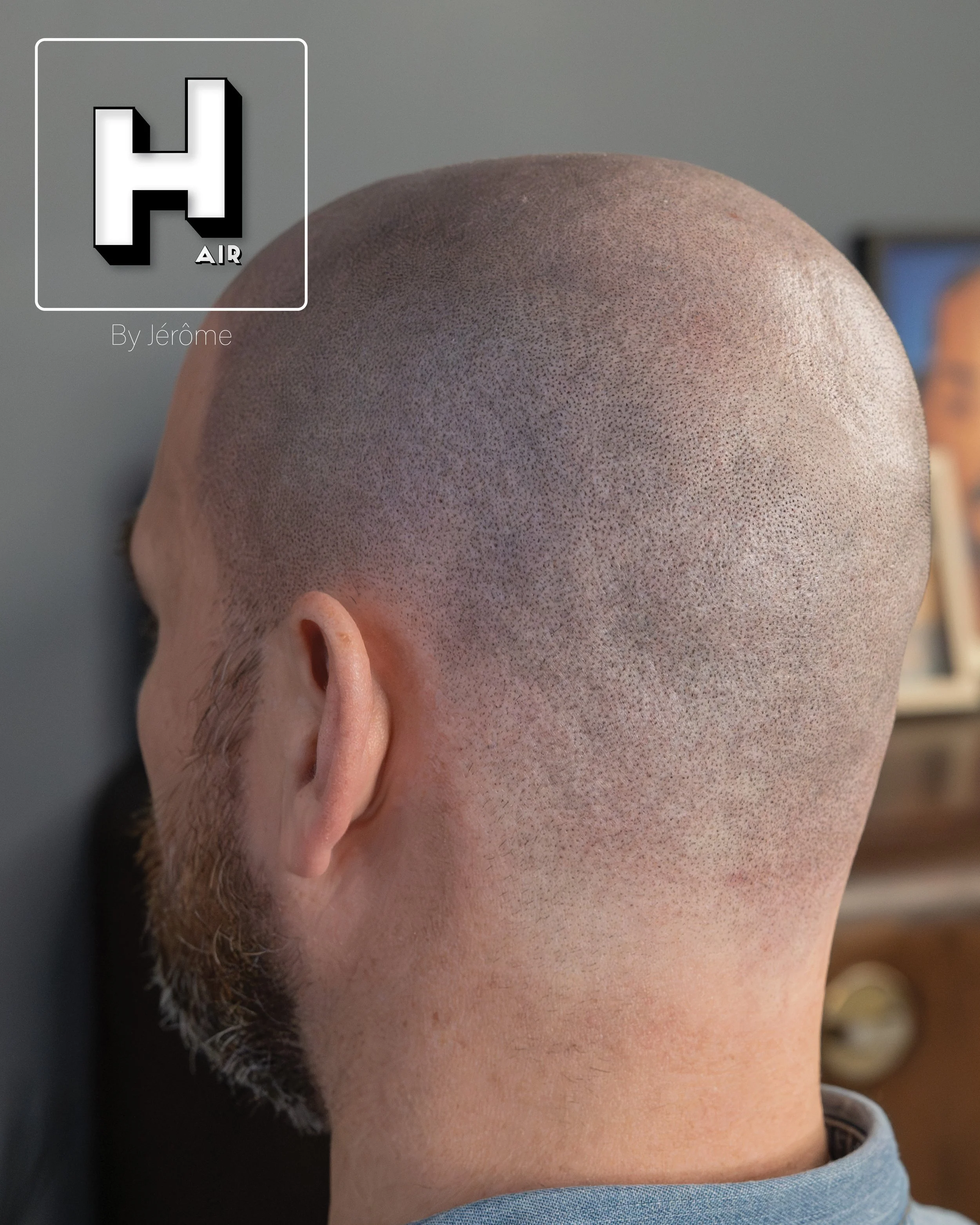 smp  effet rasé greffe cheveux turquie fue smpartistbelgium hairbyjerome28.jpg