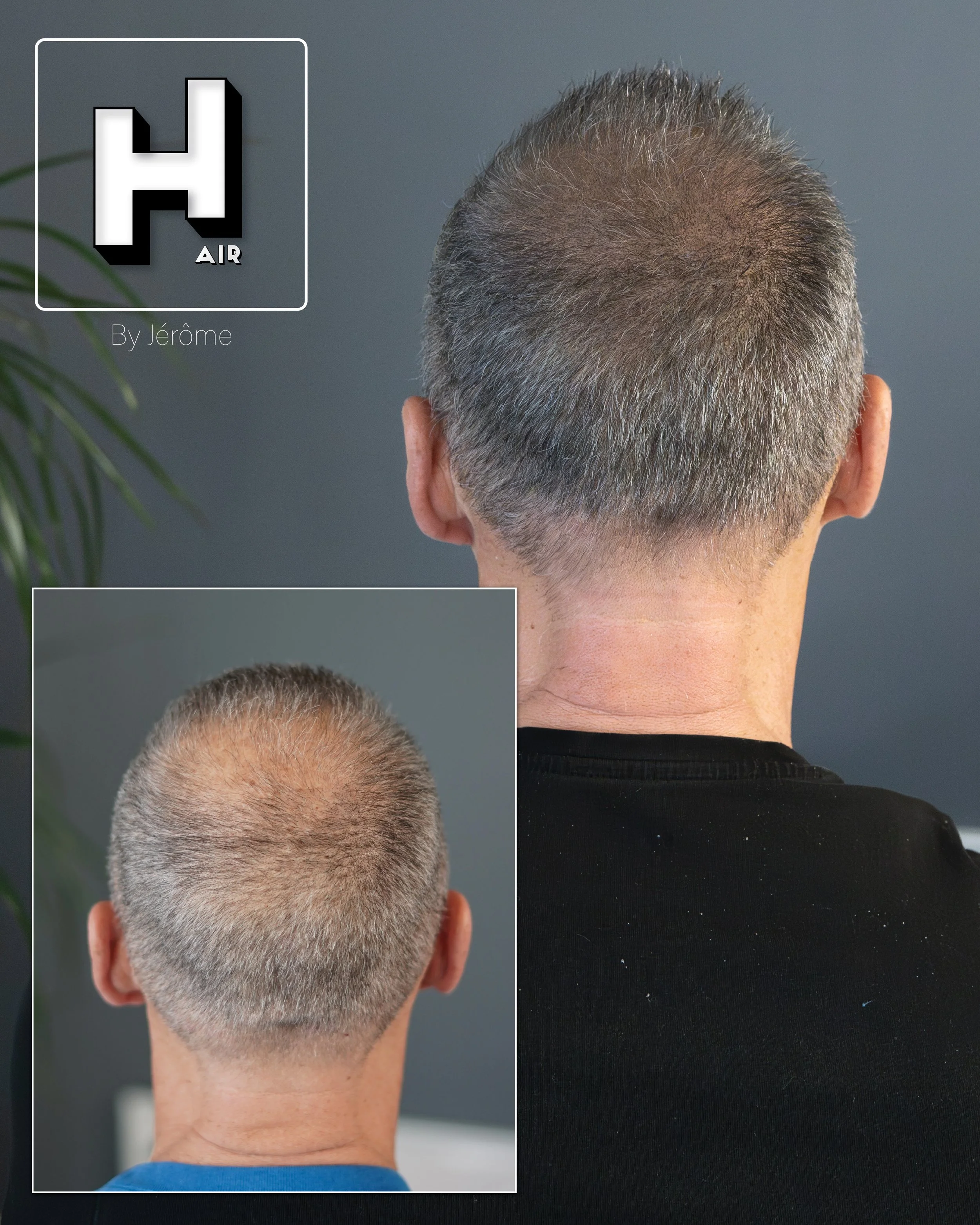 densité cheveux micro pigmentation capillaire hair by jerome namur.jpg