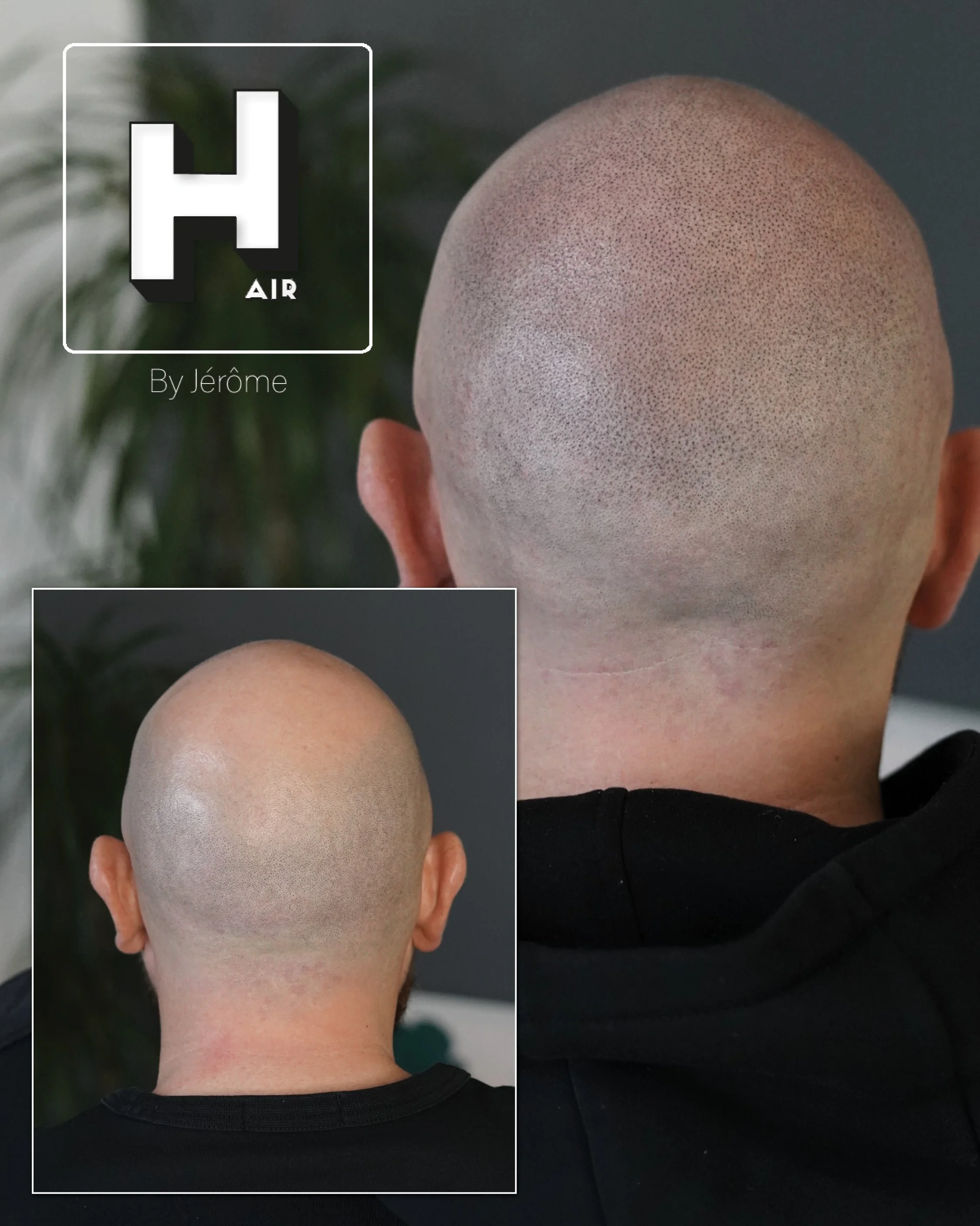 Scalp micro belgium.jpg