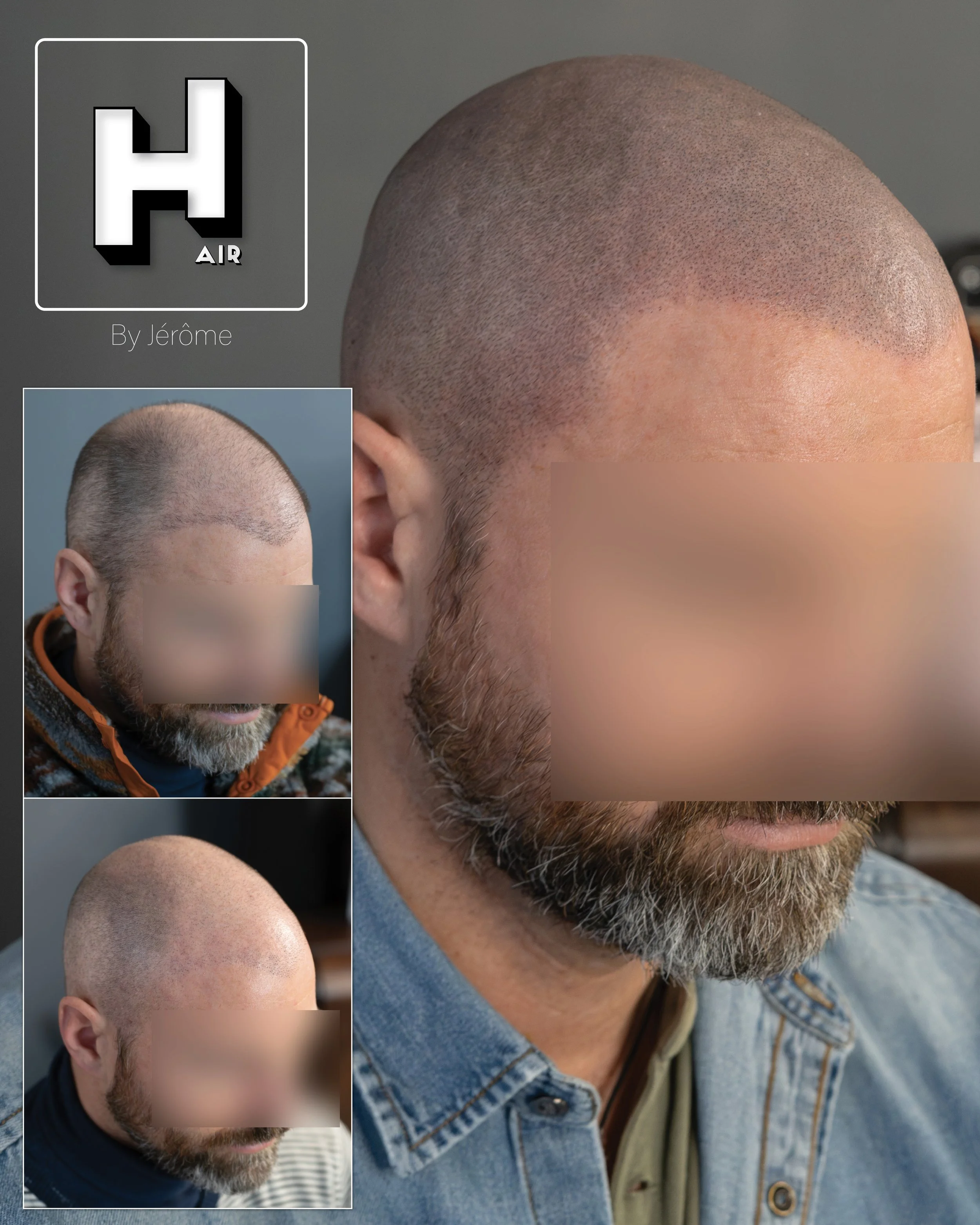 smp  effet rasé greffe cheveux turquie fue smpartistbelgium hairbyjerome13.jpg