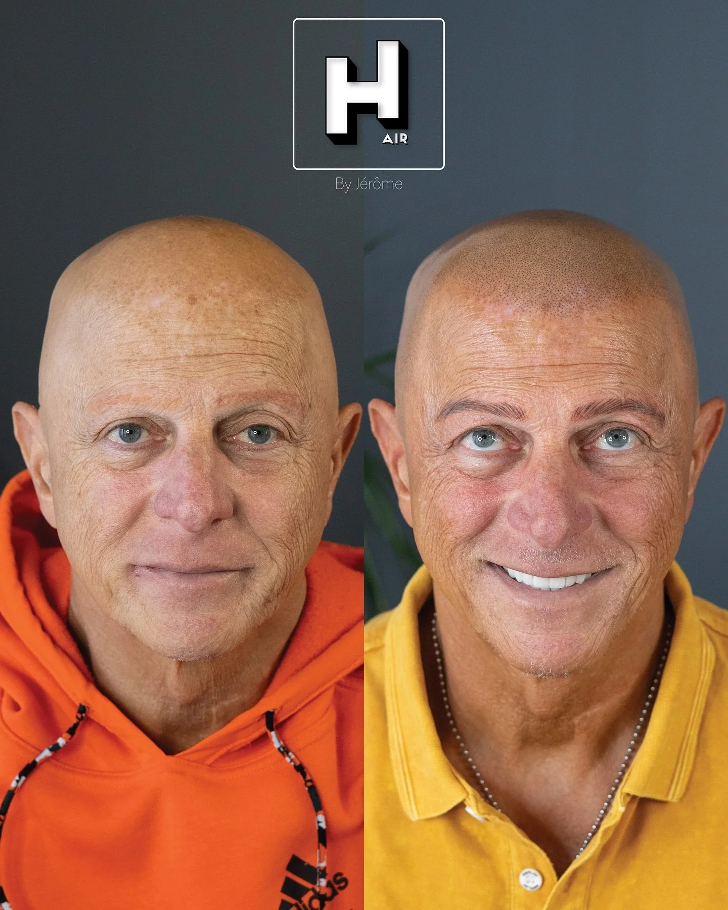 Apr&egrave;s une agression sur son lieu de travail, il a vu appara&icirc;tre une alop&eacute;cie universelle.
Une r&eacute;action extr&ecirc;me du corps au choc, qui a men&eacute; &agrave; une perte totale des cheveux et des poils.

L&rsquo;alop&eacu