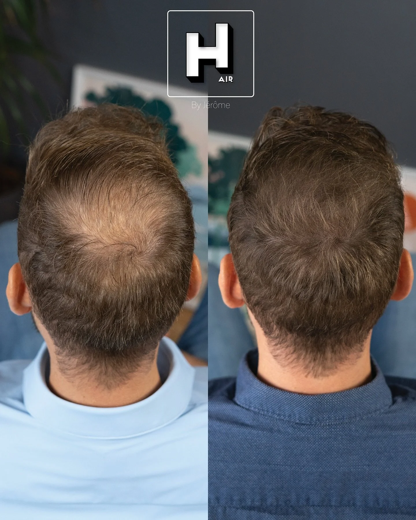 ⚠️ Ceci n&rsquo;est pas une greffe👨🏻&zwj;⚕️
En effet, pas de passage par la chirurgie pour combler ce vertex !
La greffe avait &eacute;t&eacute; effectu&eacute;e quelques ann&eacute;es auparavant par ce client, mais comme souvent cette zone ne donn