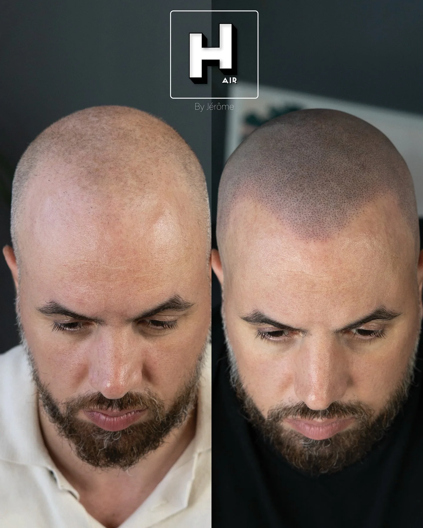 Encore une fois : aller plus loin en SMP que ce que la greffe offre r&eacute;ellement.
La greffe, quand elle est justifi&eacute;e et bien ex&eacute;cut&eacute;e, est une solution g&eacute;niale.
Cependant, dans bien trop de cas, elle est r&eacute;ali