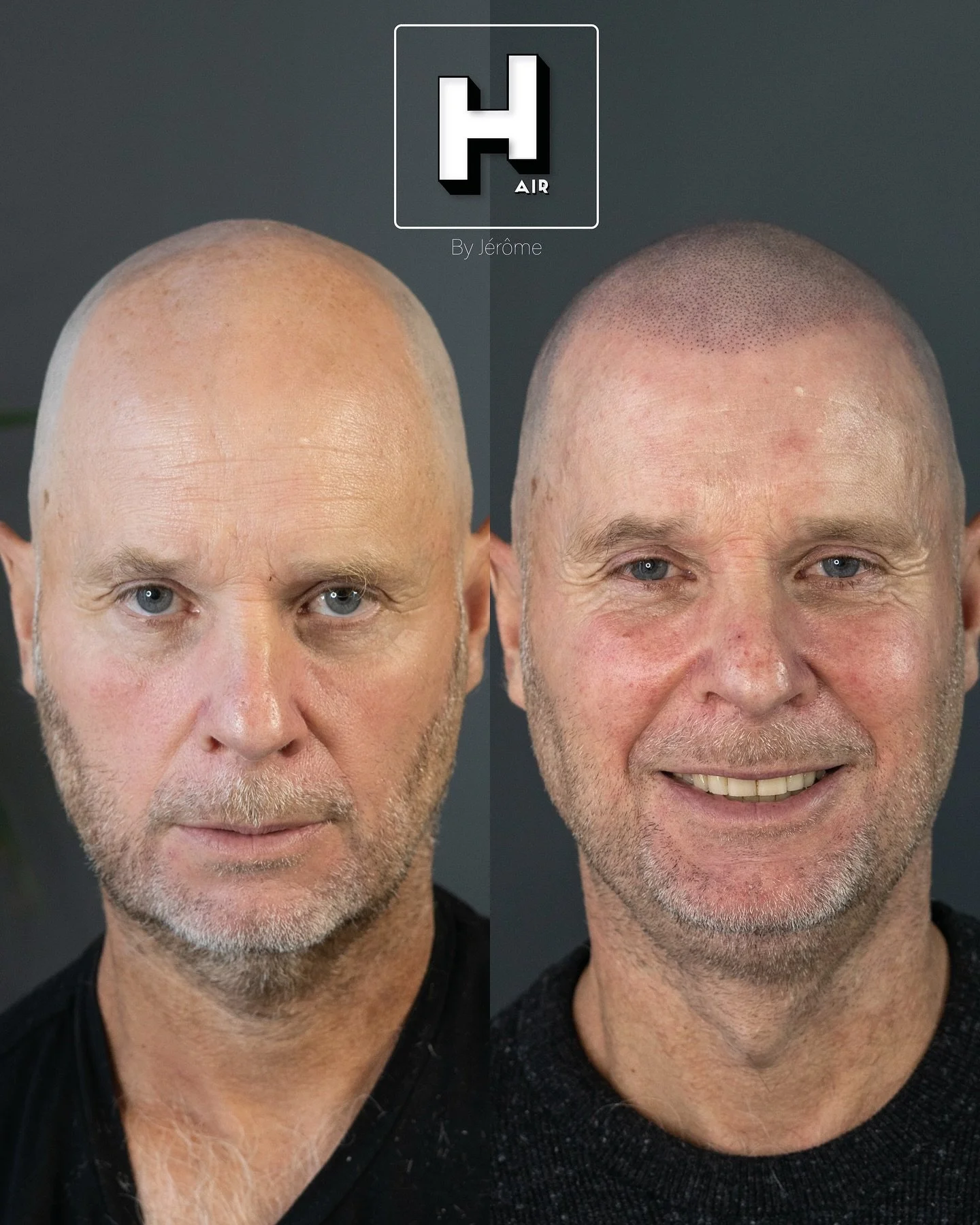 Brave the Shave ! ⚔️💪🏻
La meilleure d&eacute;cision qu&rsquo;un homme peut prendre lorsque la perte de cheveux est trop importante, c&rsquo;est d&rsquo;oser se raser !
Et derri&egrave;re cette lib&eacute;ration, un effet ras&eacute; en SMP lui donn