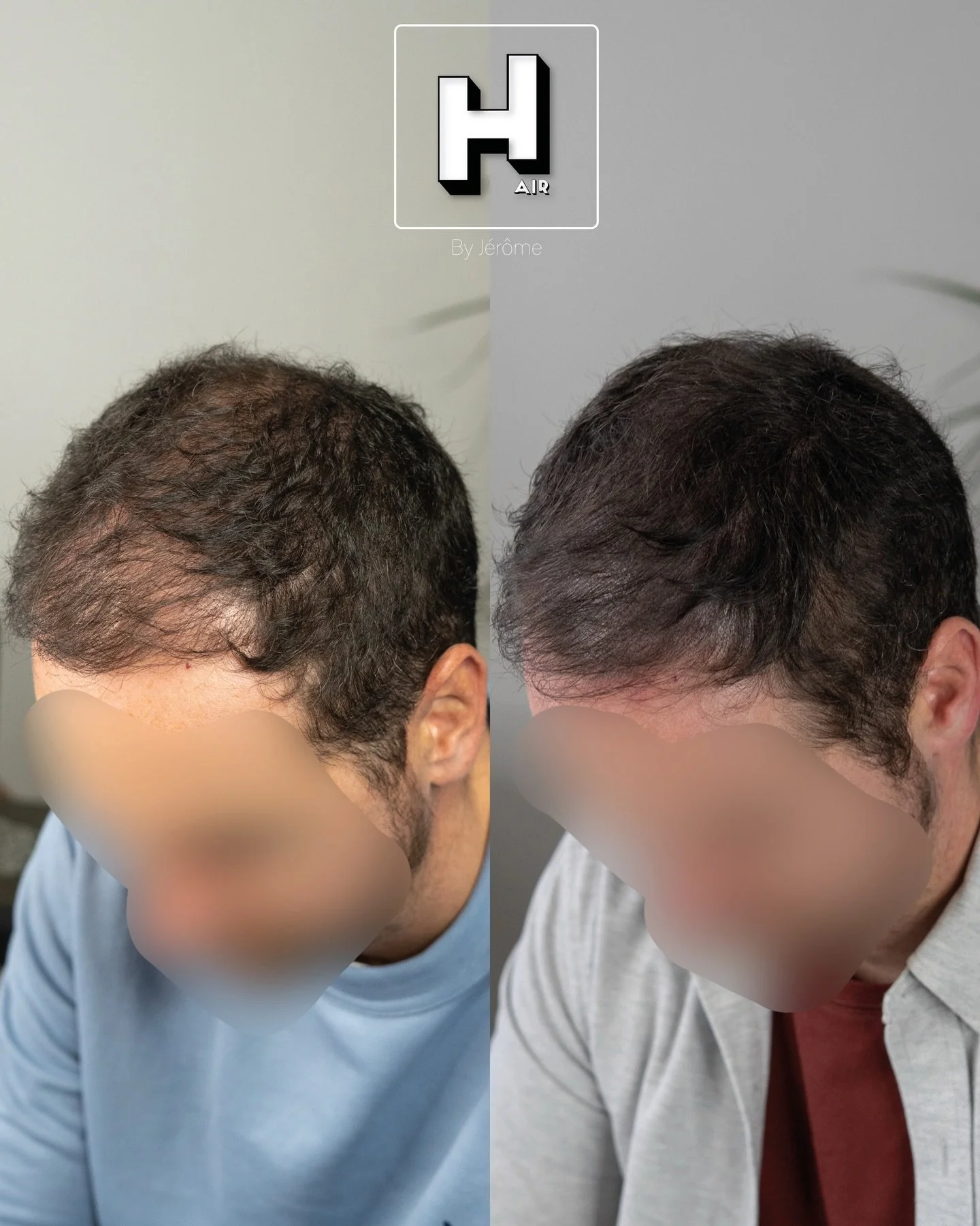 Aider la greffe de cheveux en y apportant la densit&eacute; manquante, c&rsquo;est un des nombreux avantages de la SMP 💪🏻
R&eacute;serve ta consultation gratuite d&egrave;s maintenant 👇🏻 👉🏻 www.hairbyjerome.be 👉🏻 0477 524108 👉🏻hairbyjerome.