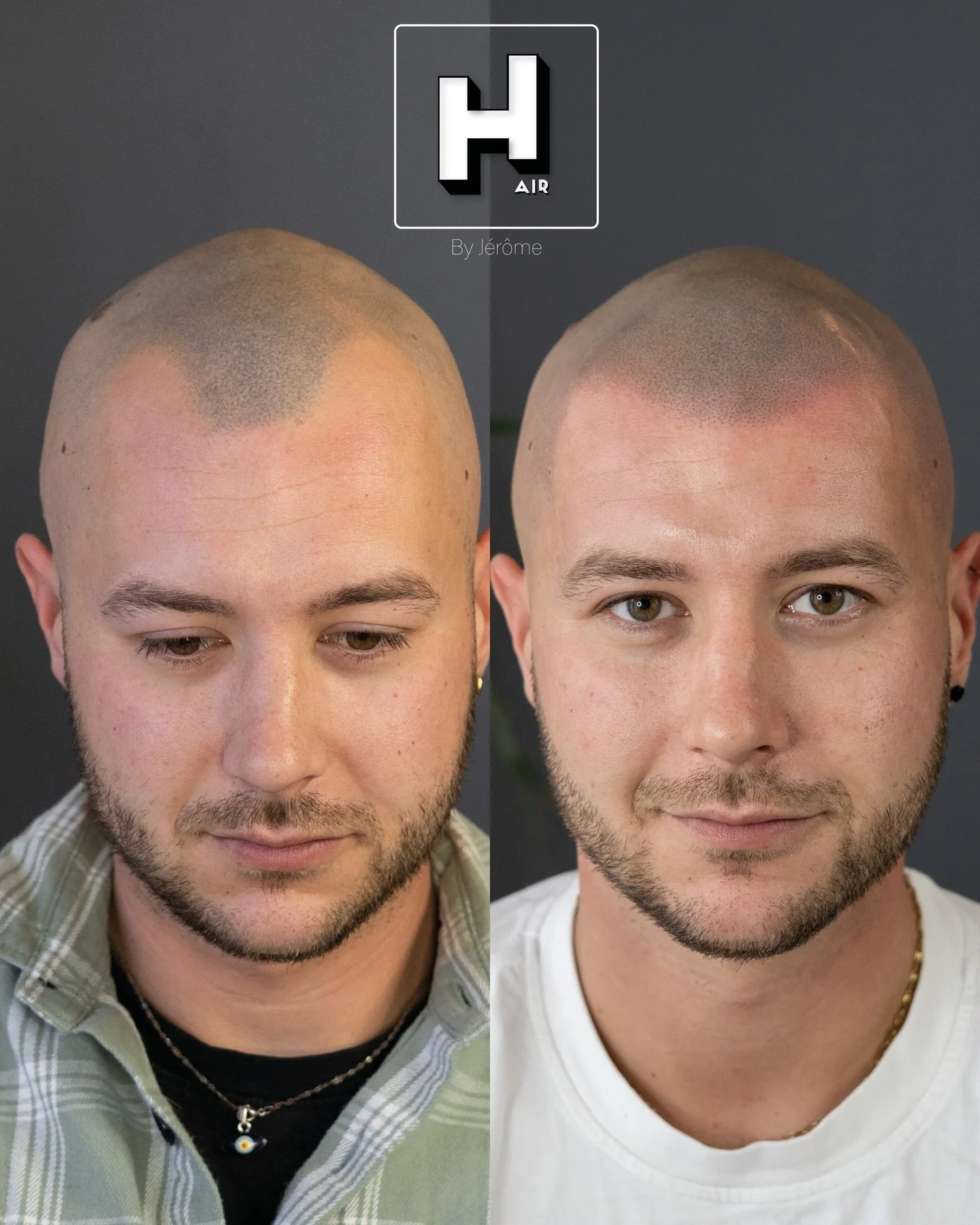 Had a old density effect, no laser removal, brave the shave ⚔️, and now get a brand new hairline 😍💪🏻
.
R&eacute;serve ta consultation gratuite d&egrave;s maintenant 👇🏻 👉🏻 www.hairbyjerome.be 👉🏻 0477 524108 👉🏻hairbyjerome.namur@gmail.com . 