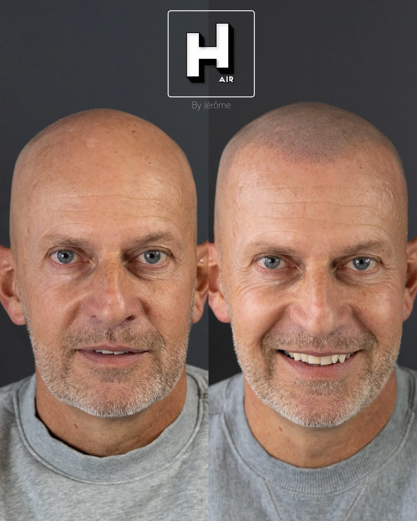 Un effet ras&eacute; comme on les aime 😍
Ultra naturel, ind&eacute;tectable, une ligne frontale adapt&eacute;e &agrave; la physionomie du visage et une couronne qui a disparue 👑🧐💪🏻
R&eacute;serve ta consultation gratuite d&egrave;s maintenant 👇