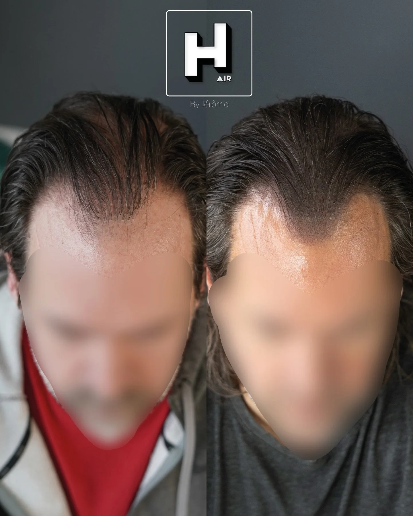 Quand un dermatologue s&rsquo;improvise chirurgien en greffe de cheveux, &ccedil;a ne peut pas &ecirc;tre couronn&eacute; de succ&egrave;s 🤦🏻&zwj;♂️
&Ccedil;a se passe &agrave; Li&egrave;ge, et malheureusement gr&acirc;ce &agrave; son statut les ge