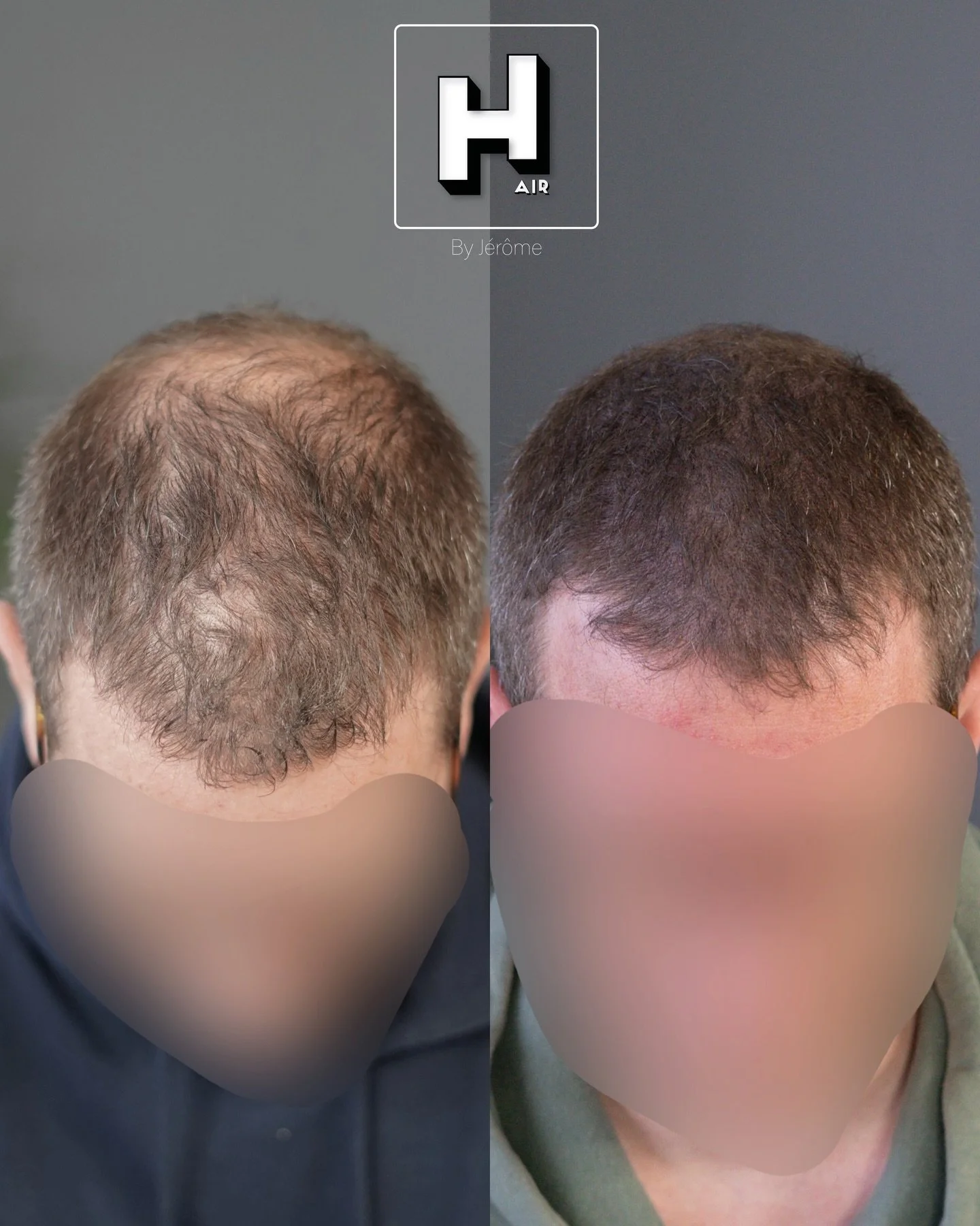 No worry, just add density 🙌🏻

R&eacute;serve ta consultation gratuite d&egrave;s maintenant 👇🏻 👉🏻 www.hairbyjerome.be 👉🏻 0477 524108 👉🏻hairbyjerome.namur@gmail.com . &laquo;&nbsp;99 problems but my hair ain&rsquo;t one&nbsp;&raquo; . . . #