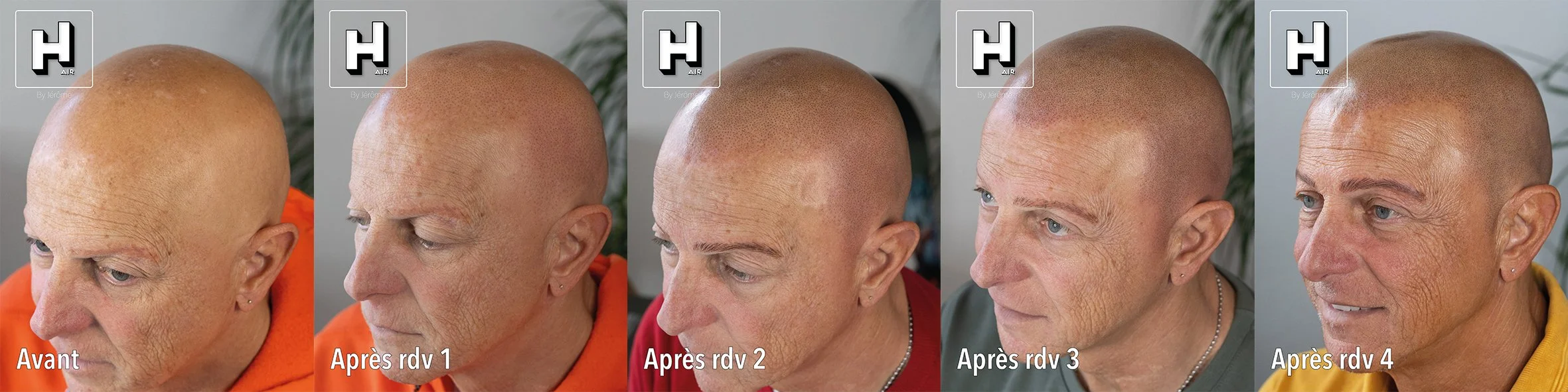 evolution SMP sur alopecie universelle3.jpg
