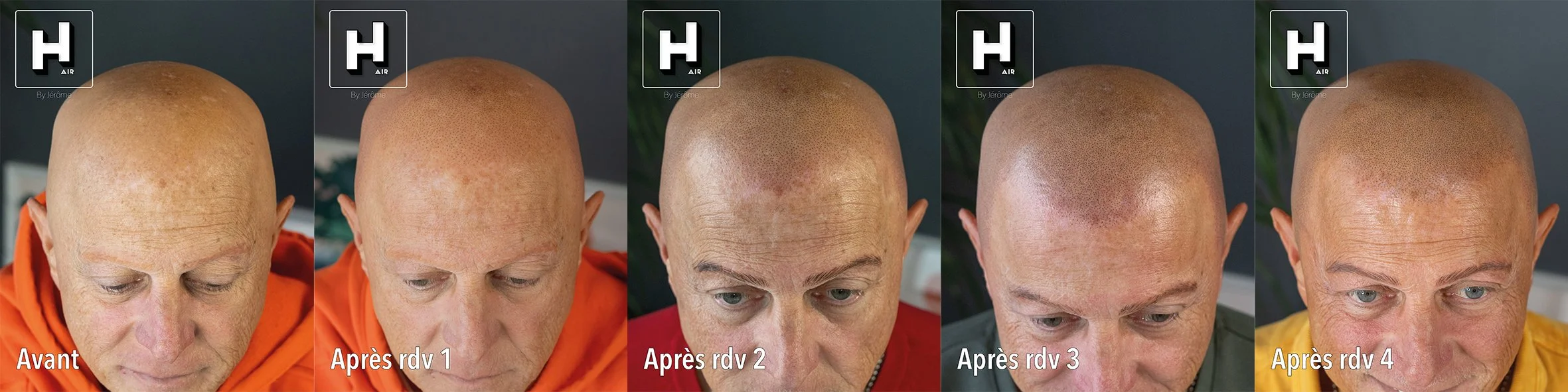 evolution SMP sur alopecie universelle2.jpg