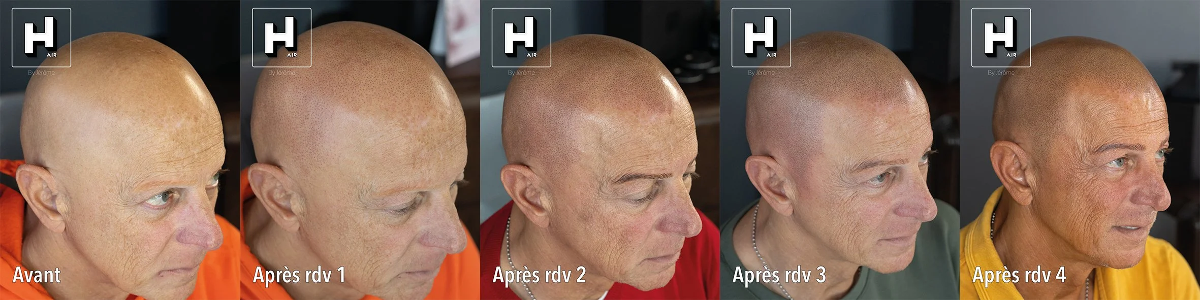 evolution SMP sur alopecie universelle4.jpg