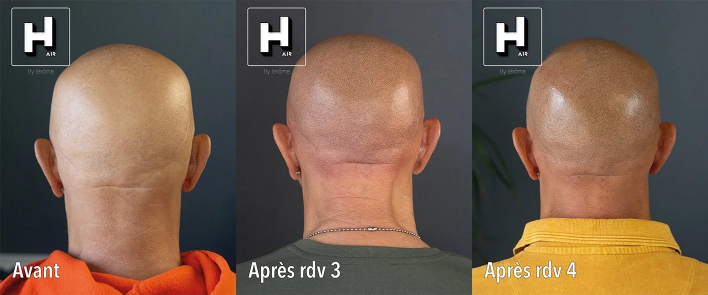 evolution SMP sur alopecie universelle5.jpg