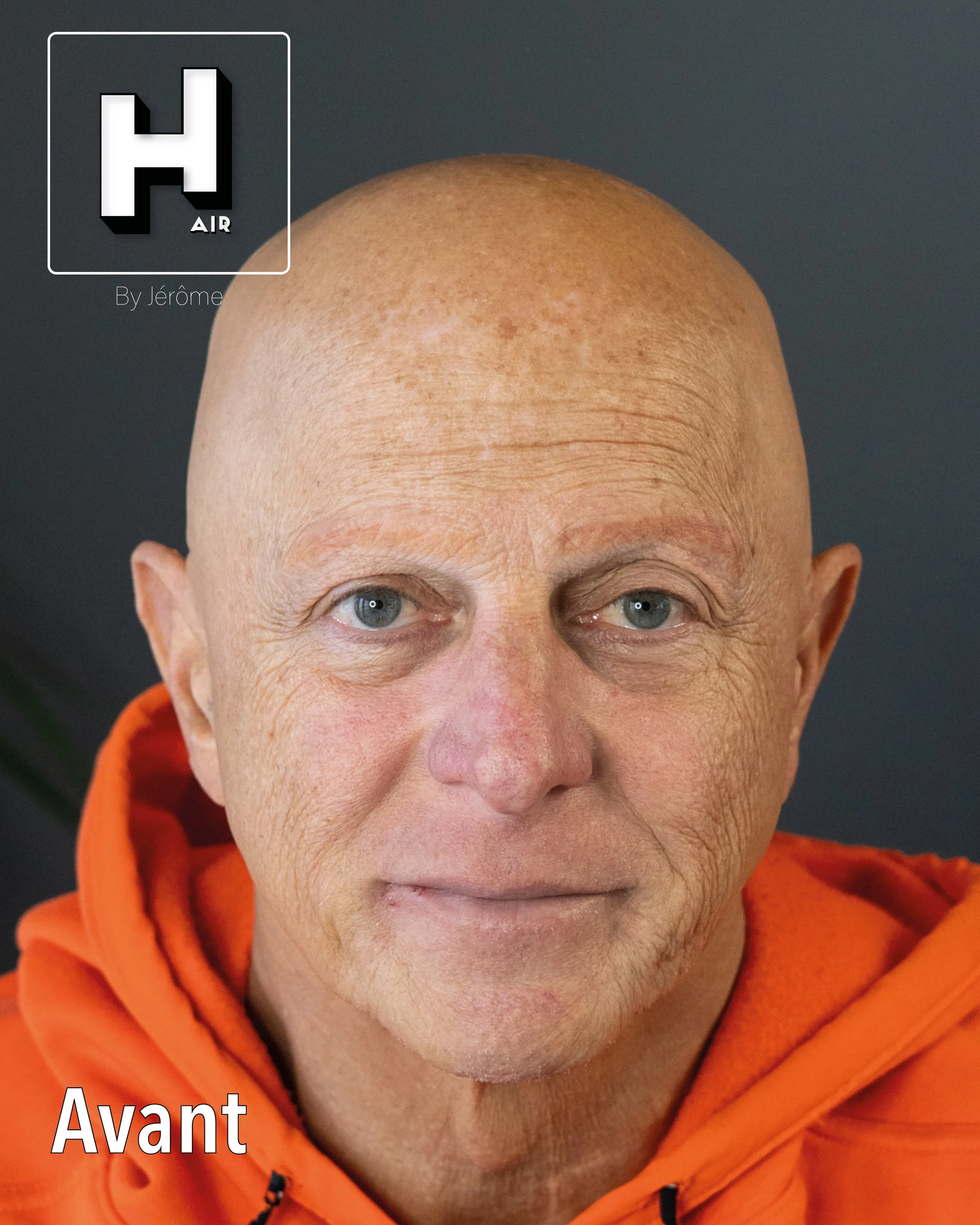 evolution alopecie universelle.jpg