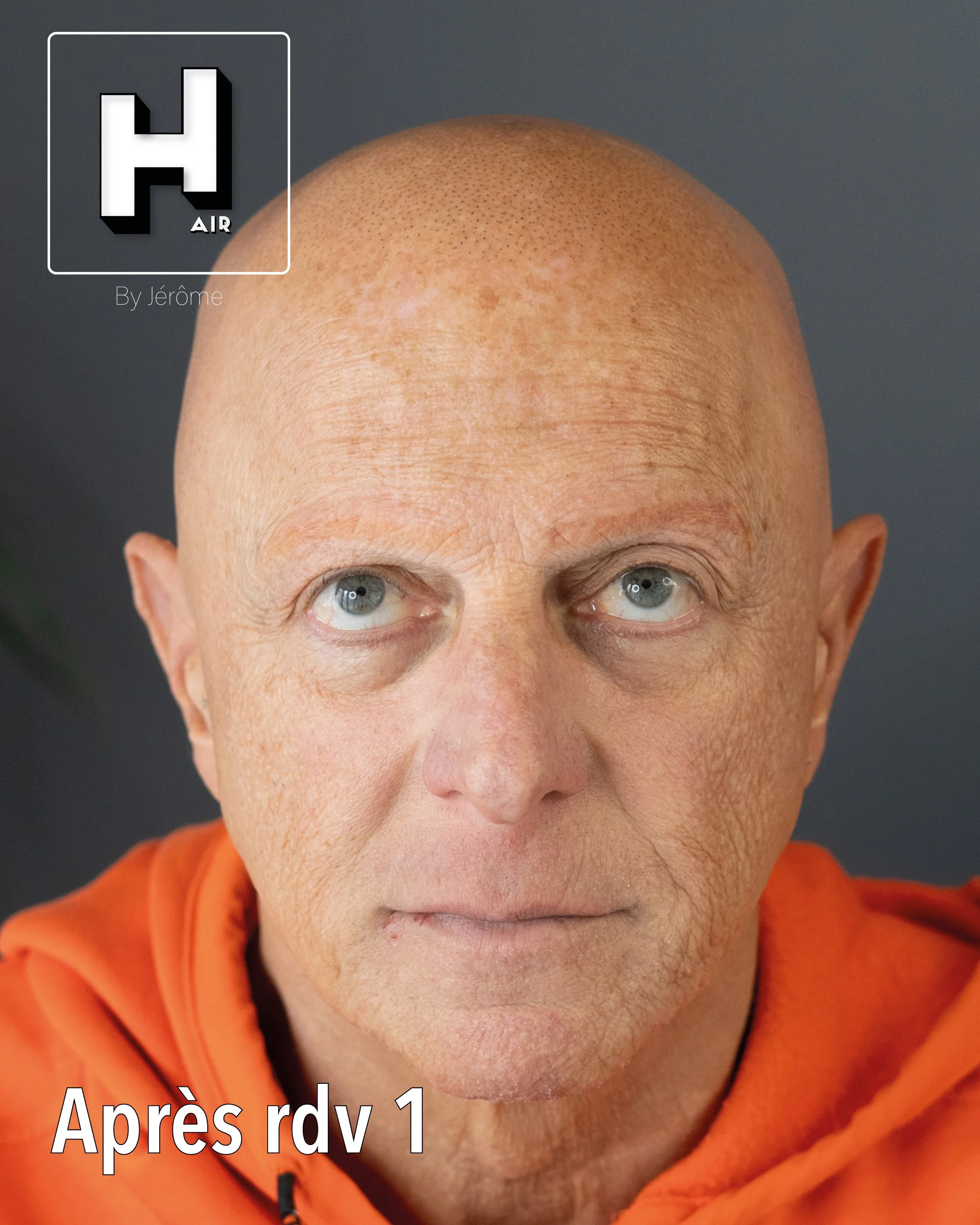 evolution alopecie universelle2.jpg