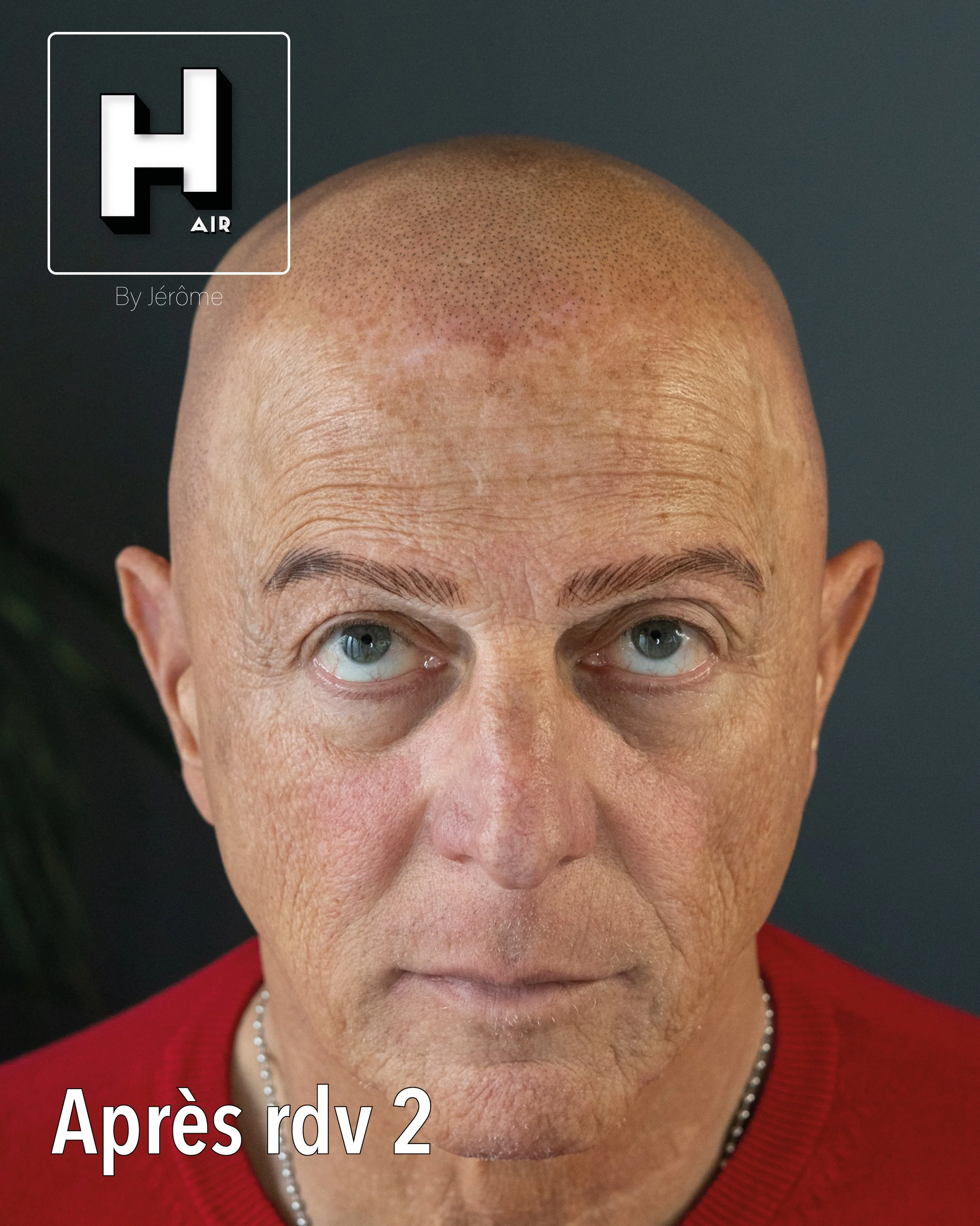 evolution alopecie universelle3.jpg