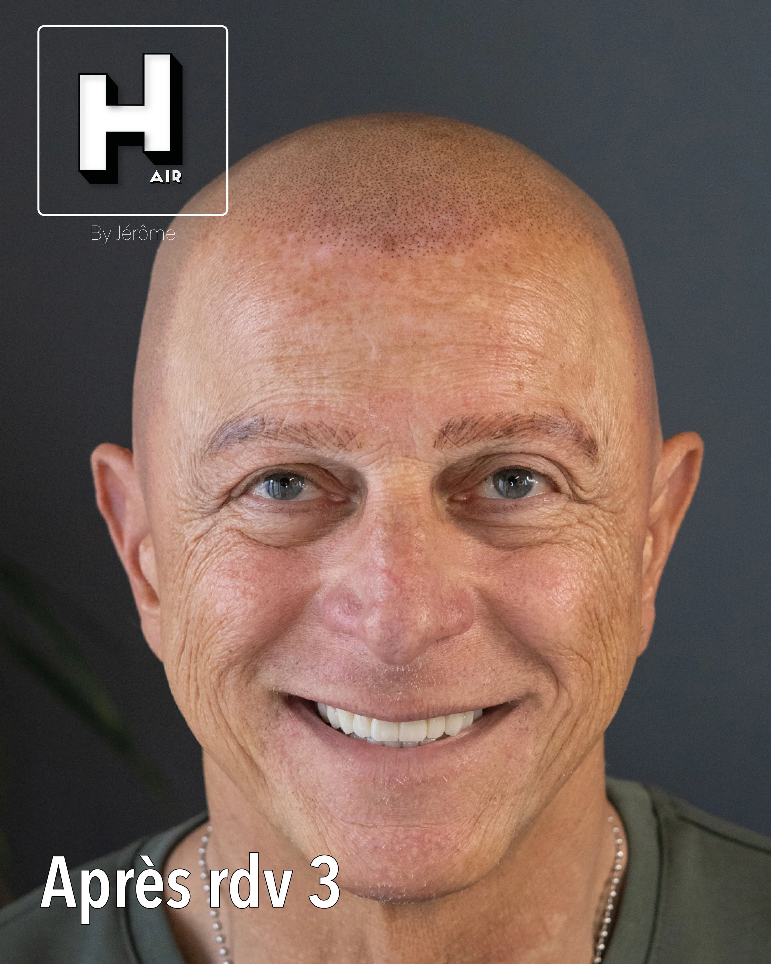 evolution alopecie universelle4.jpg