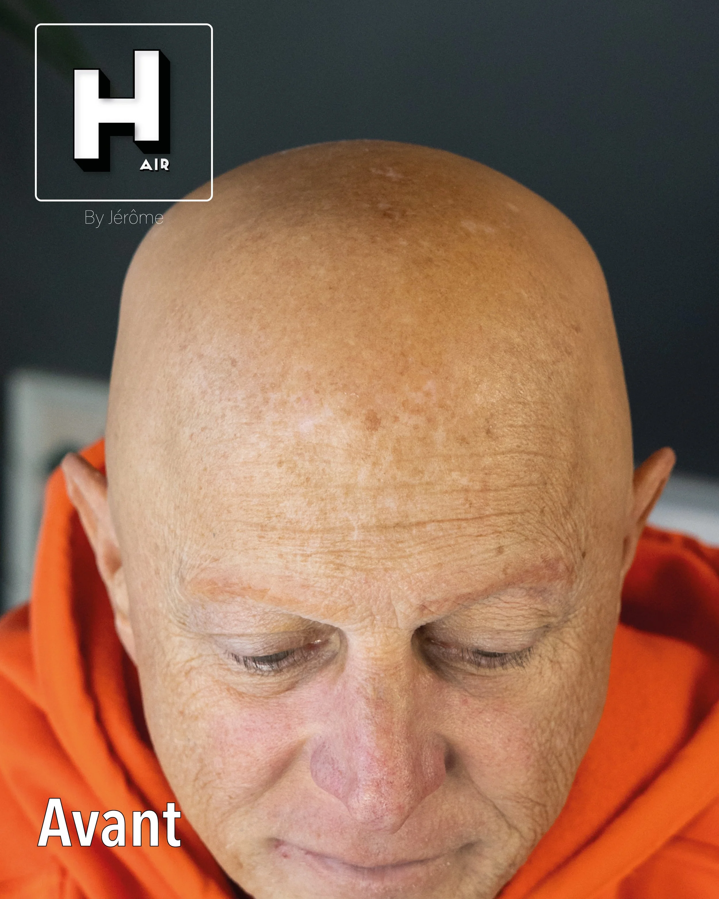 evolution alopecie universelle6.jpg