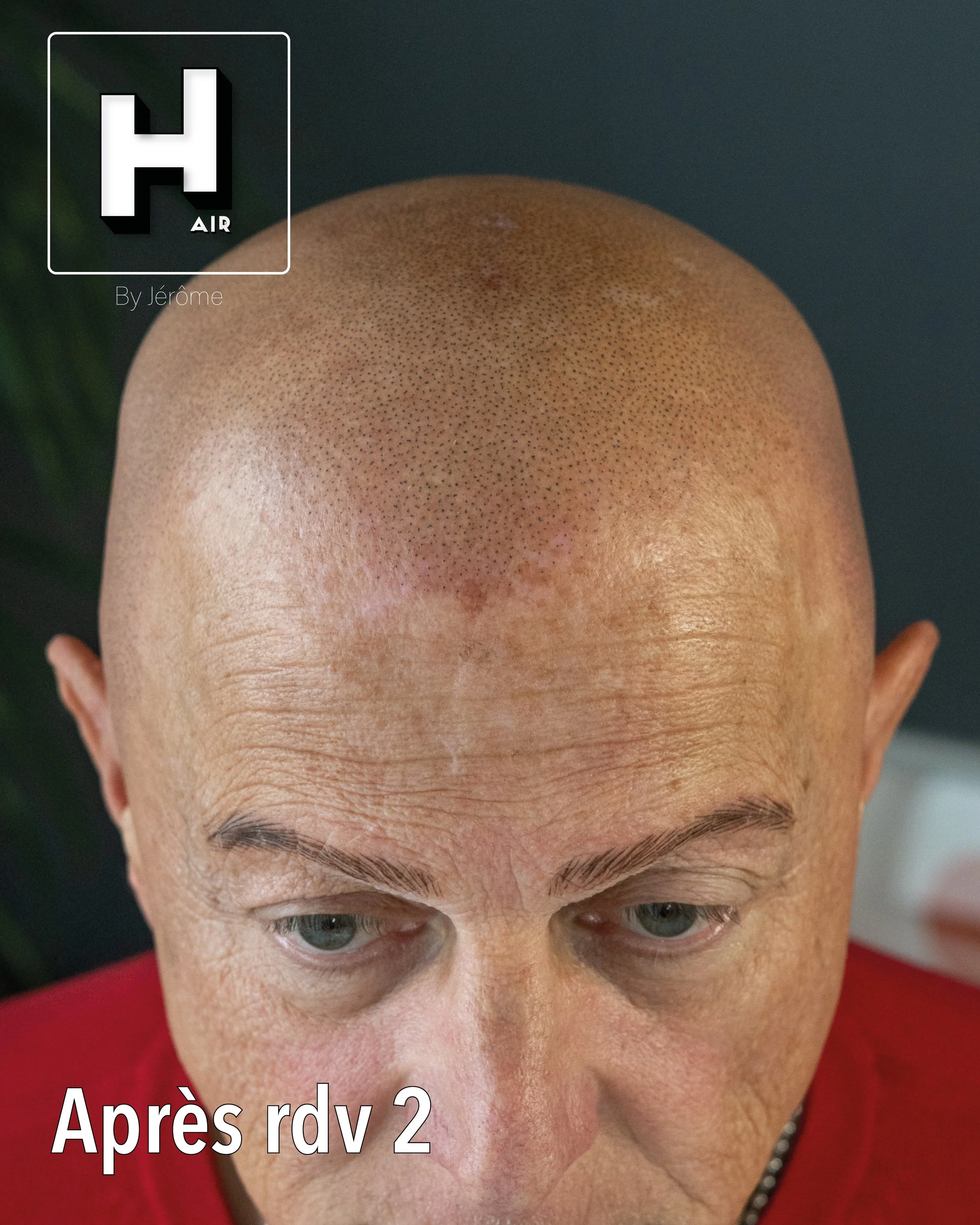 evolution alopecie universelle8.jpg