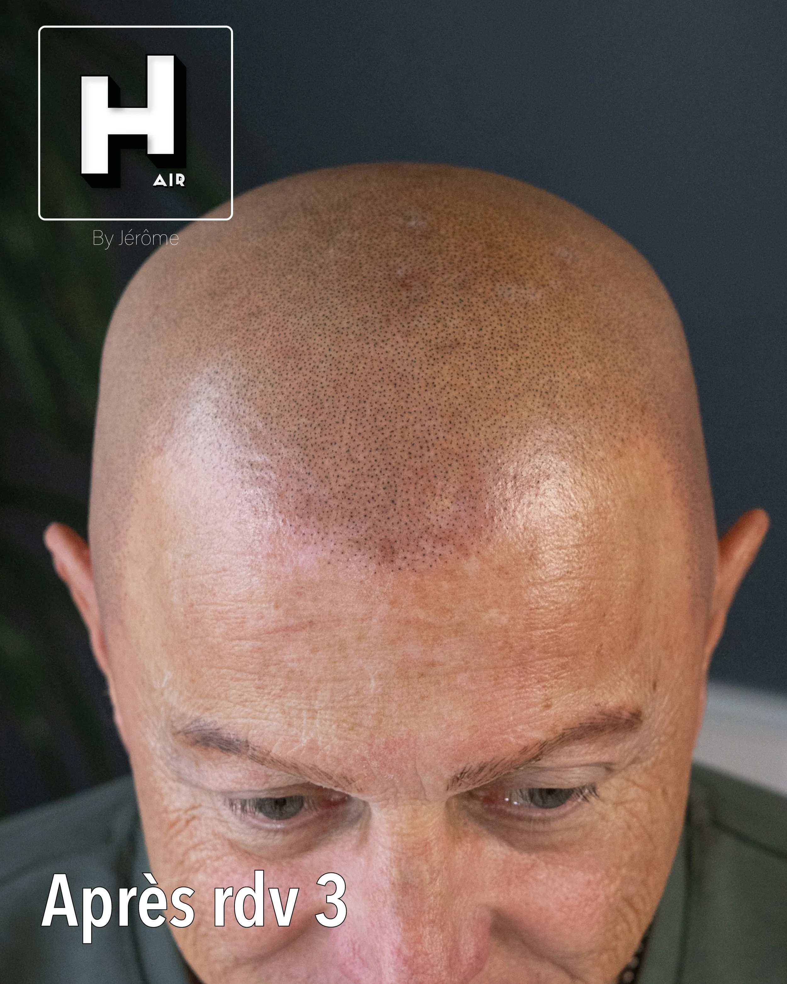 evolution alopecie universelle9.jpg