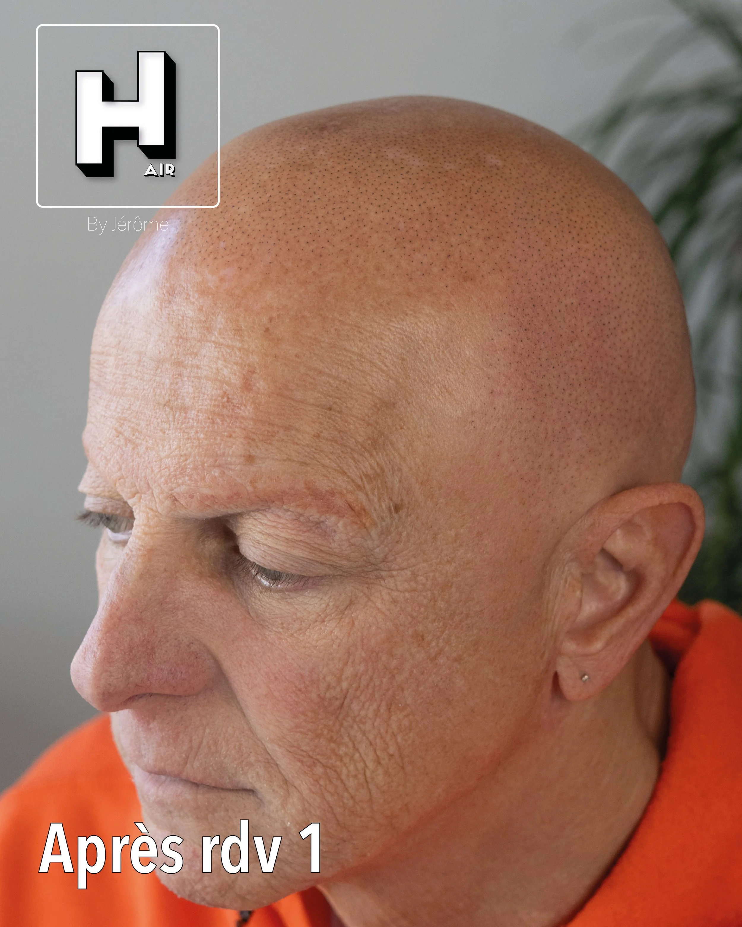 evolution alopecie universelle12.jpg
