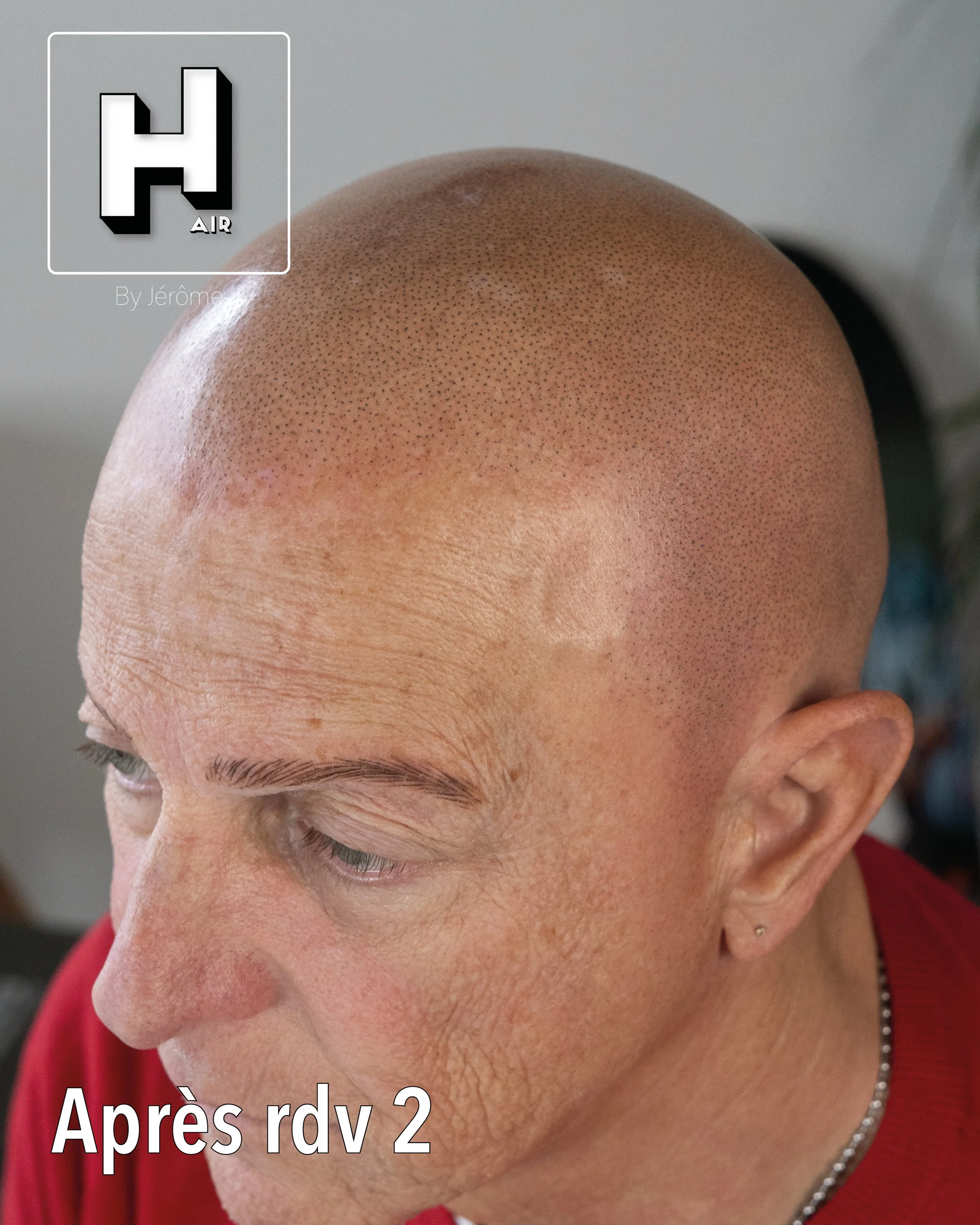 evolution alopecie universelle13.jpg