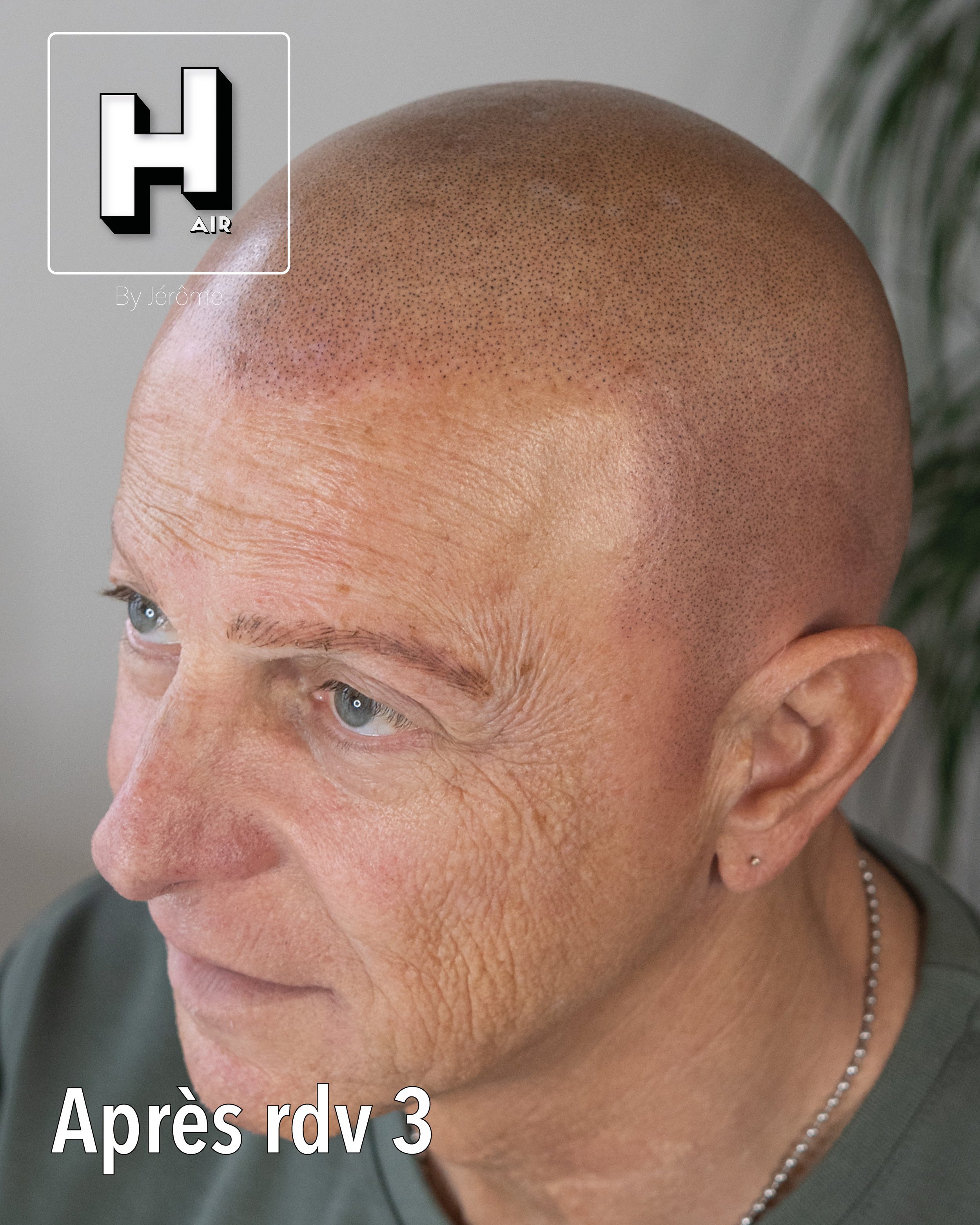 evolution alopecie universelle14.jpg