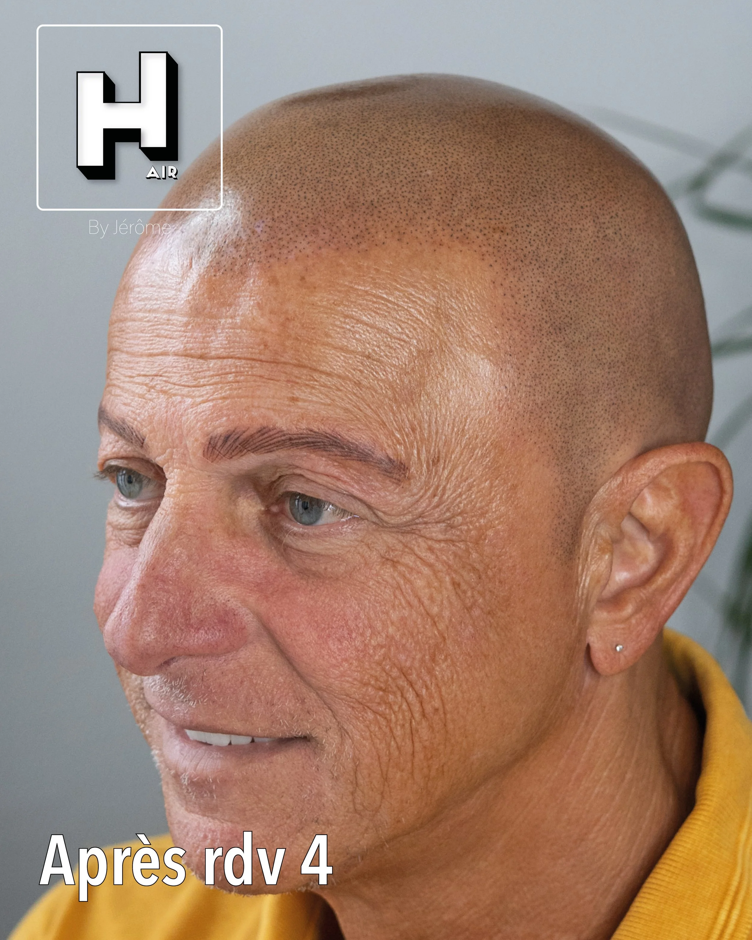 evolution alopecie universelle15.jpg