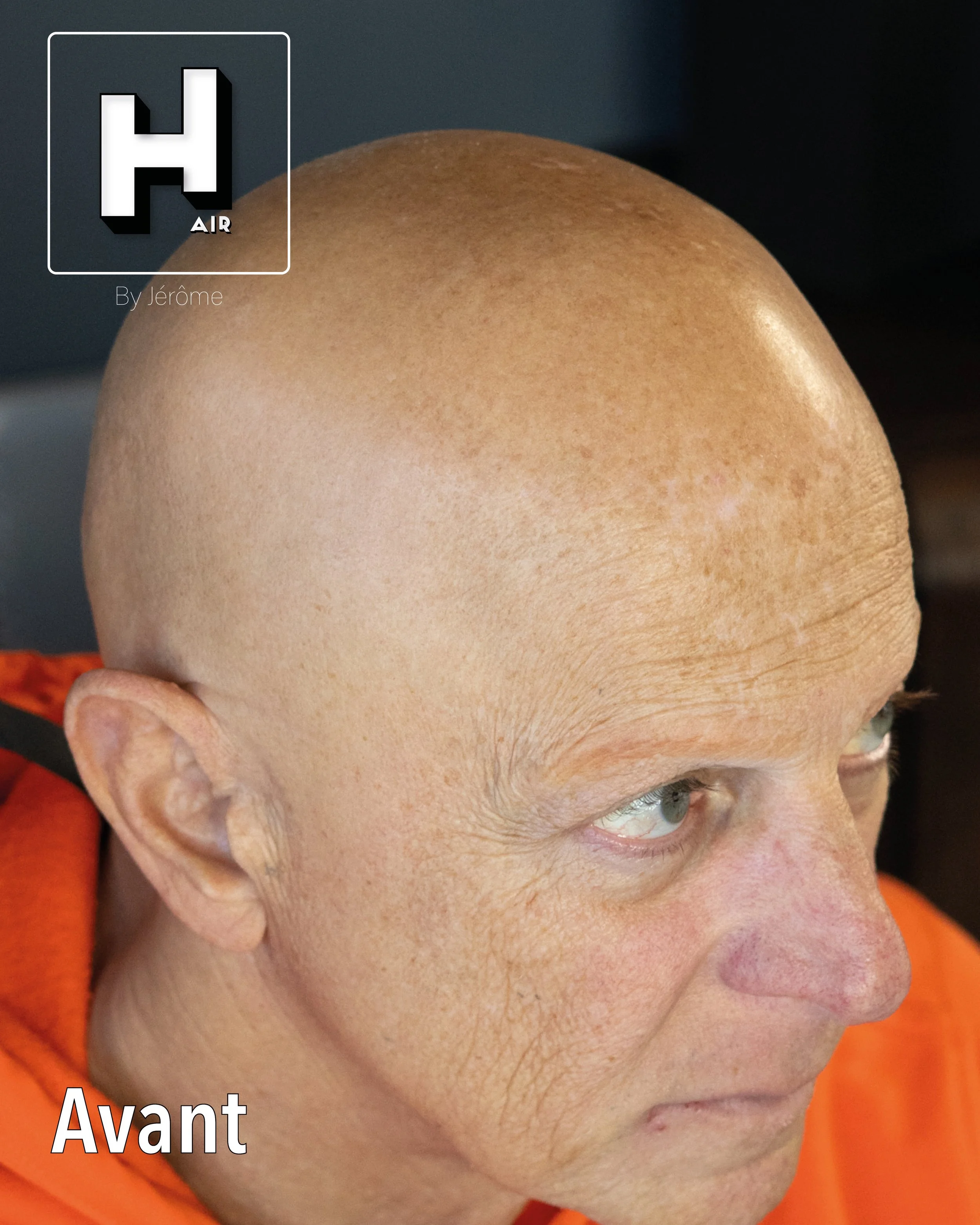 evolution alopecie universelle16.jpg