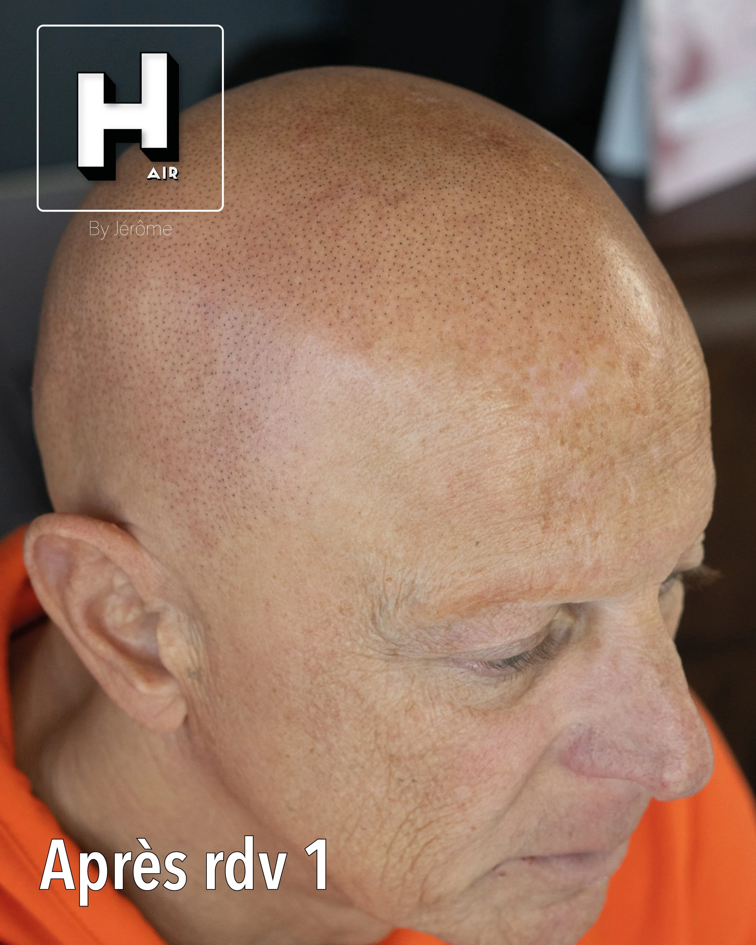 evolution alopecie universelle17.jpg