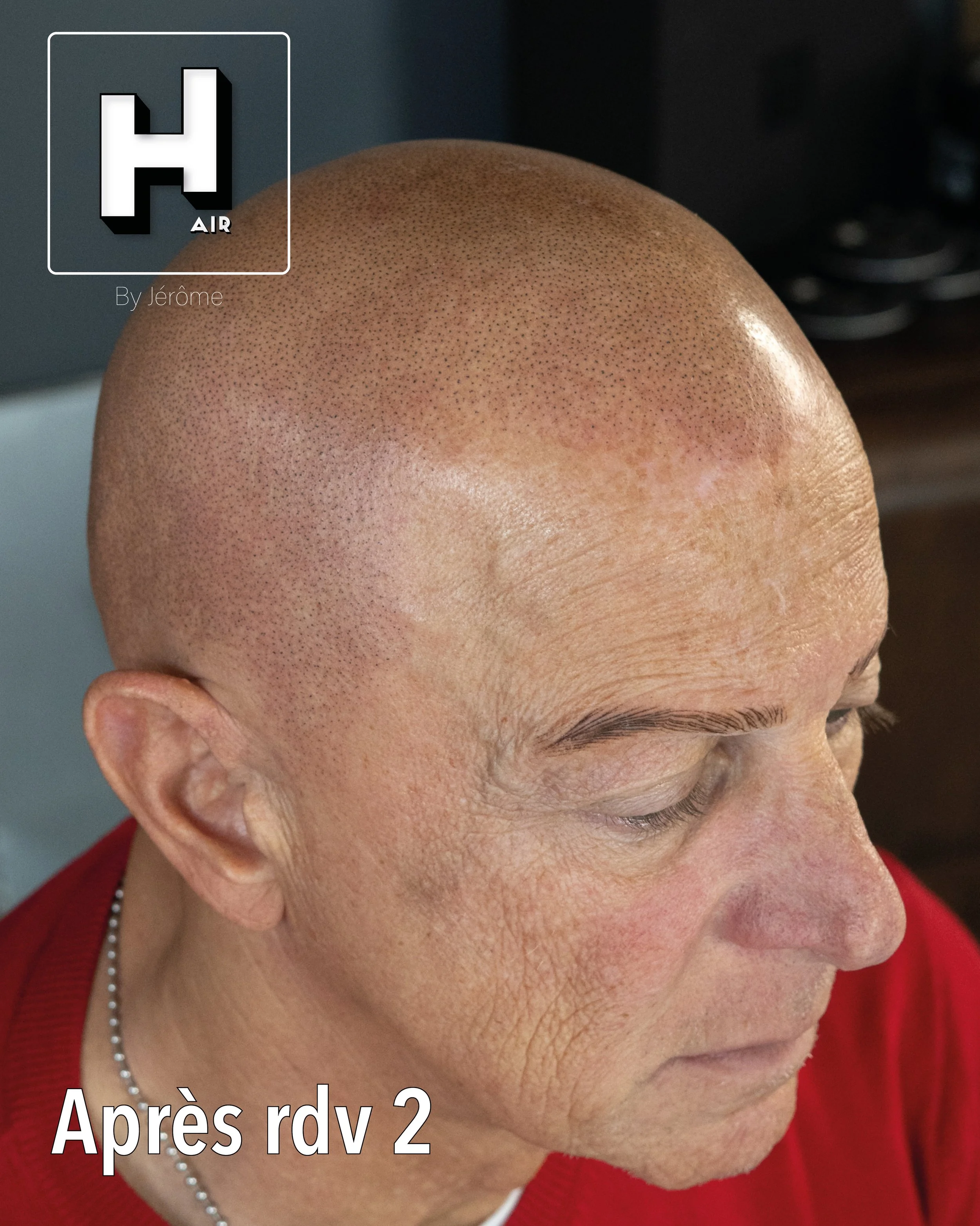 evolution alopecie universelle18.jpg