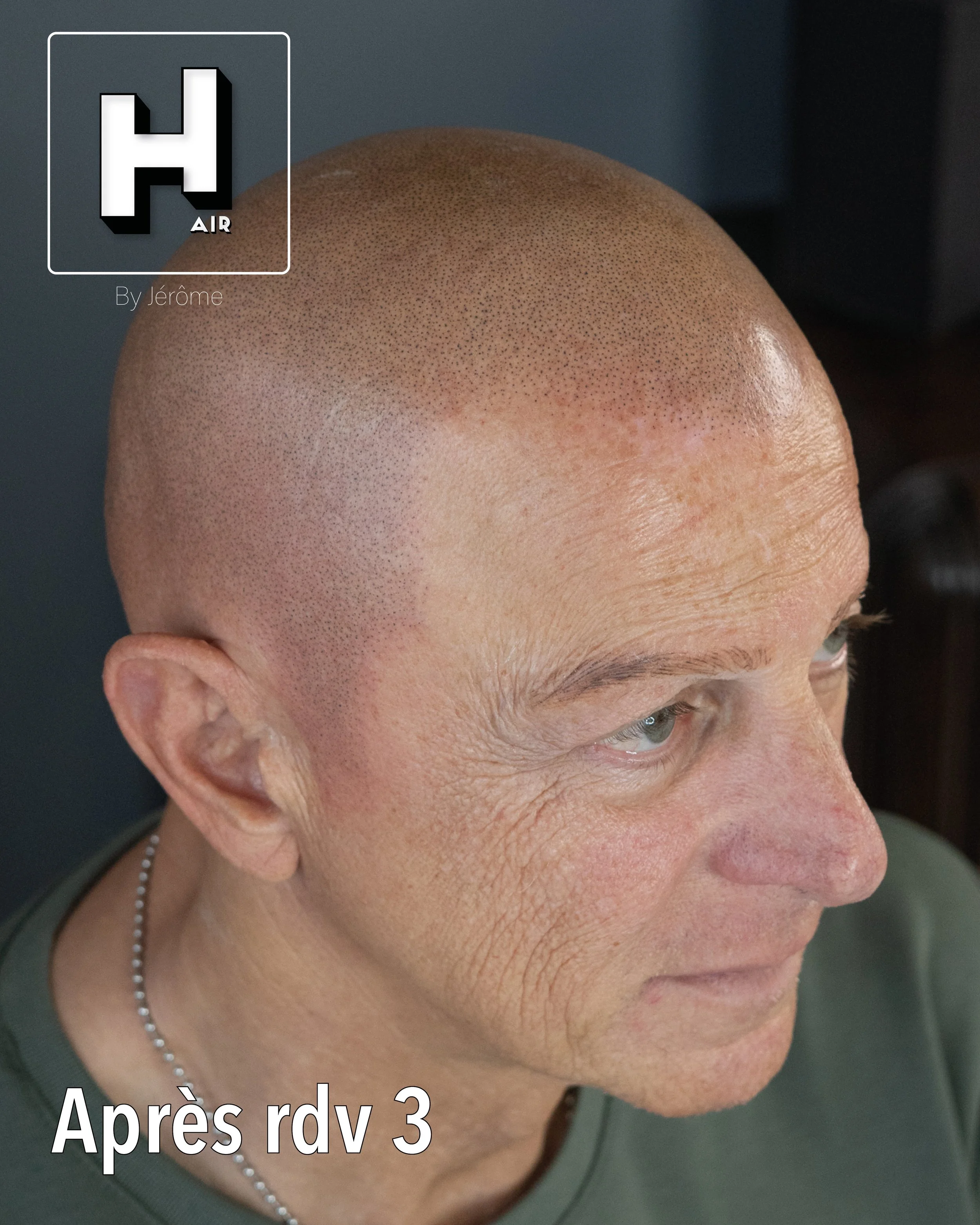 evolution alopecie universelle19.jpg