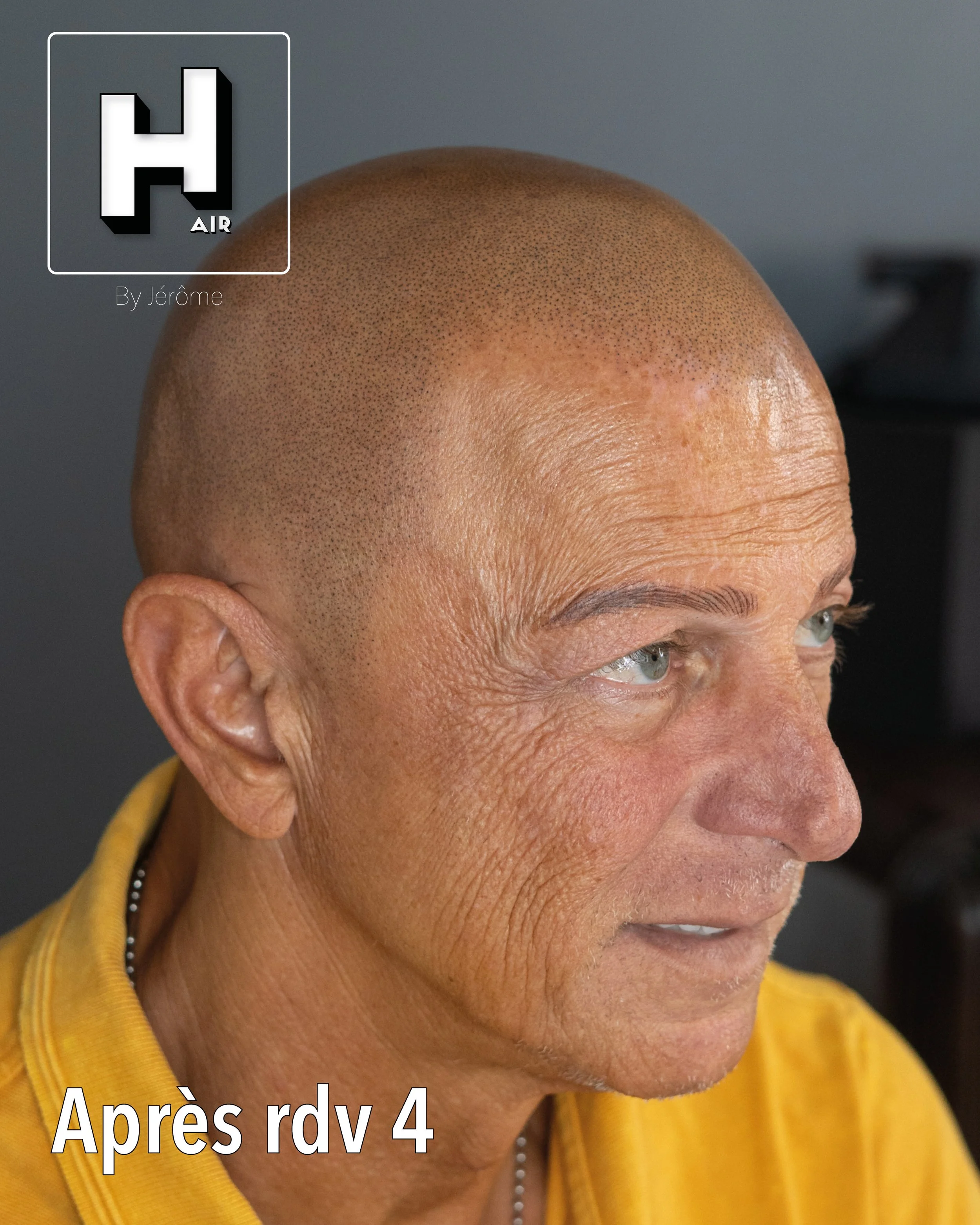evolution alopecie universelle20.jpg