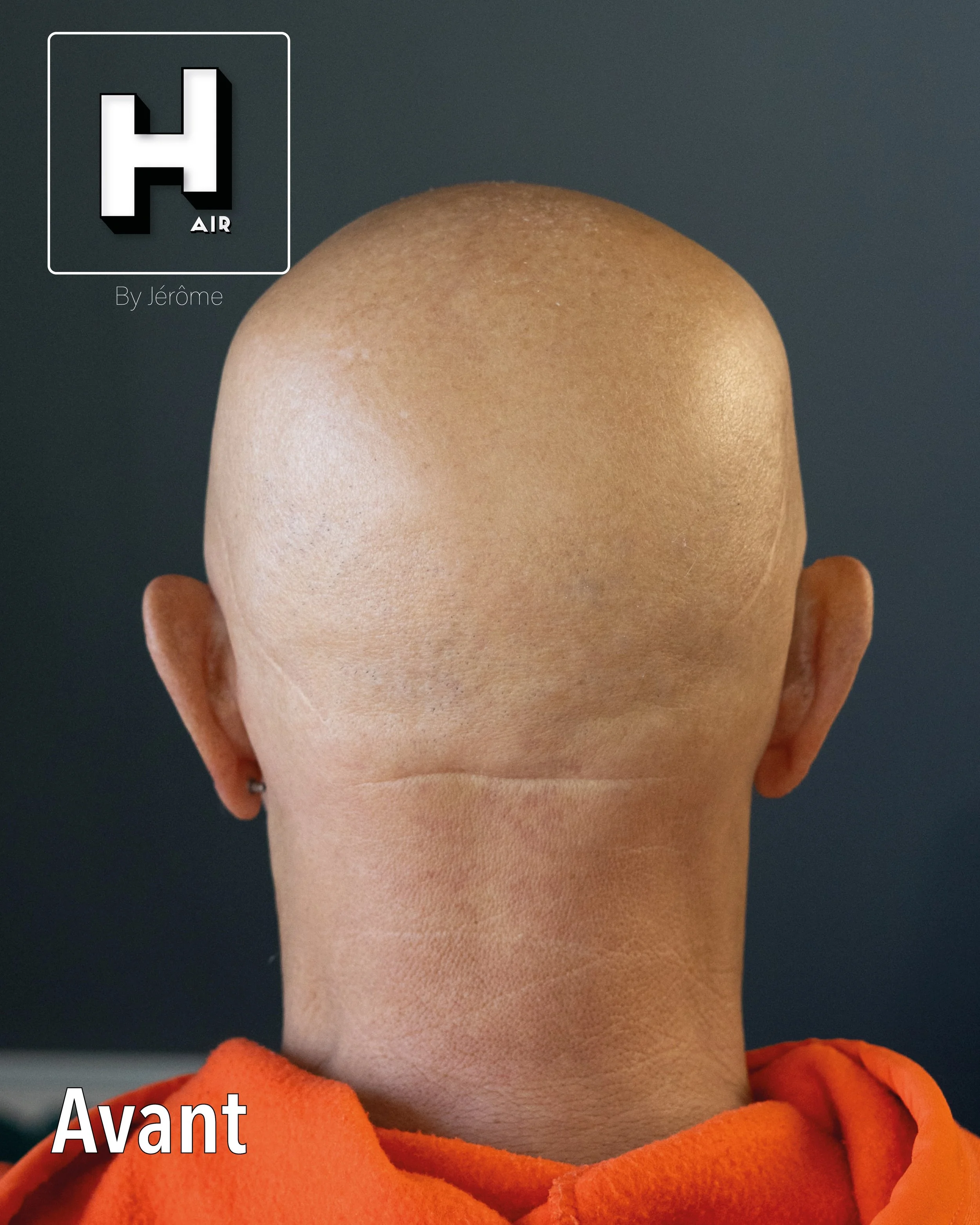 evolution alopecie universelle21.jpg