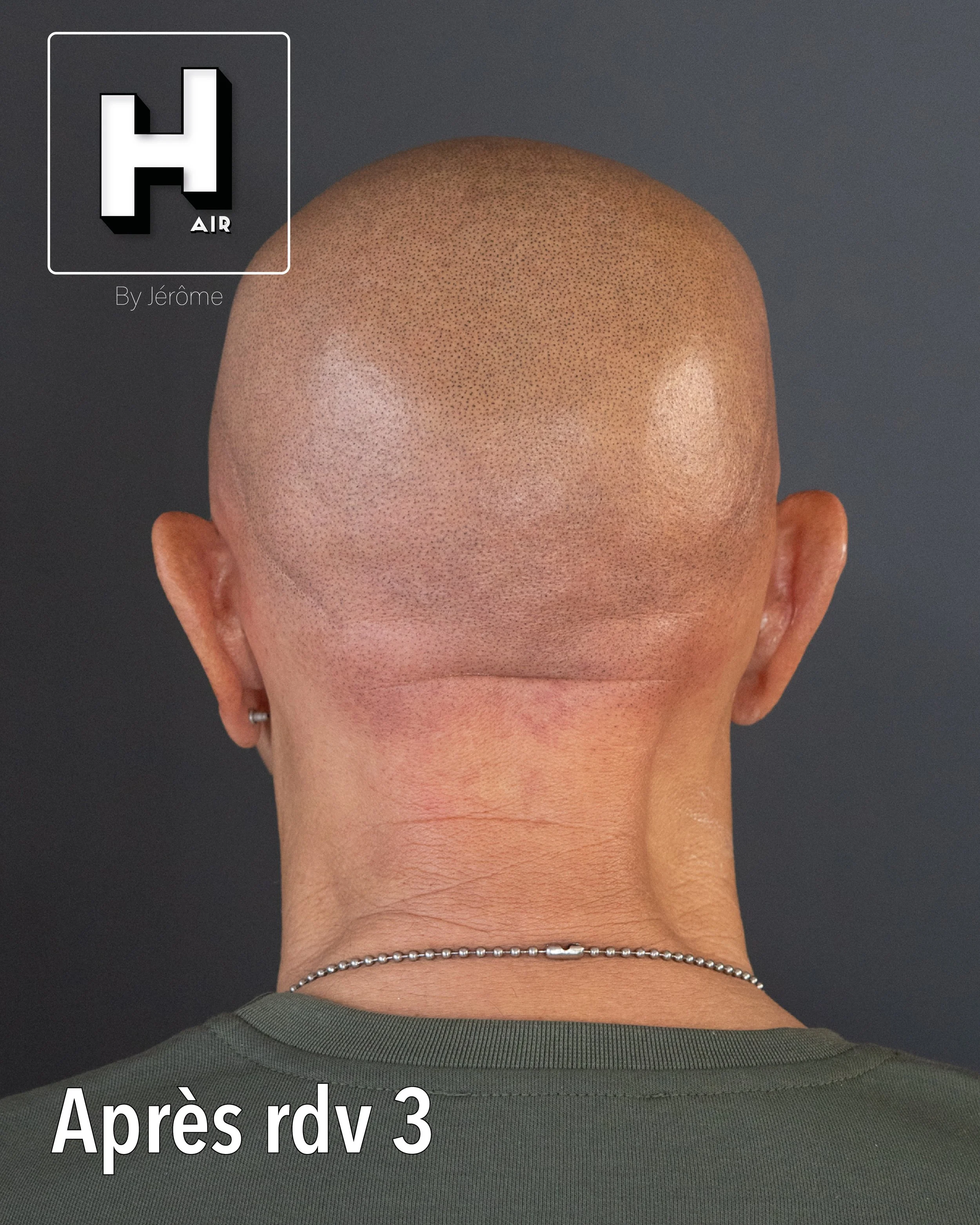 evolution alopecie universelle22.jpg