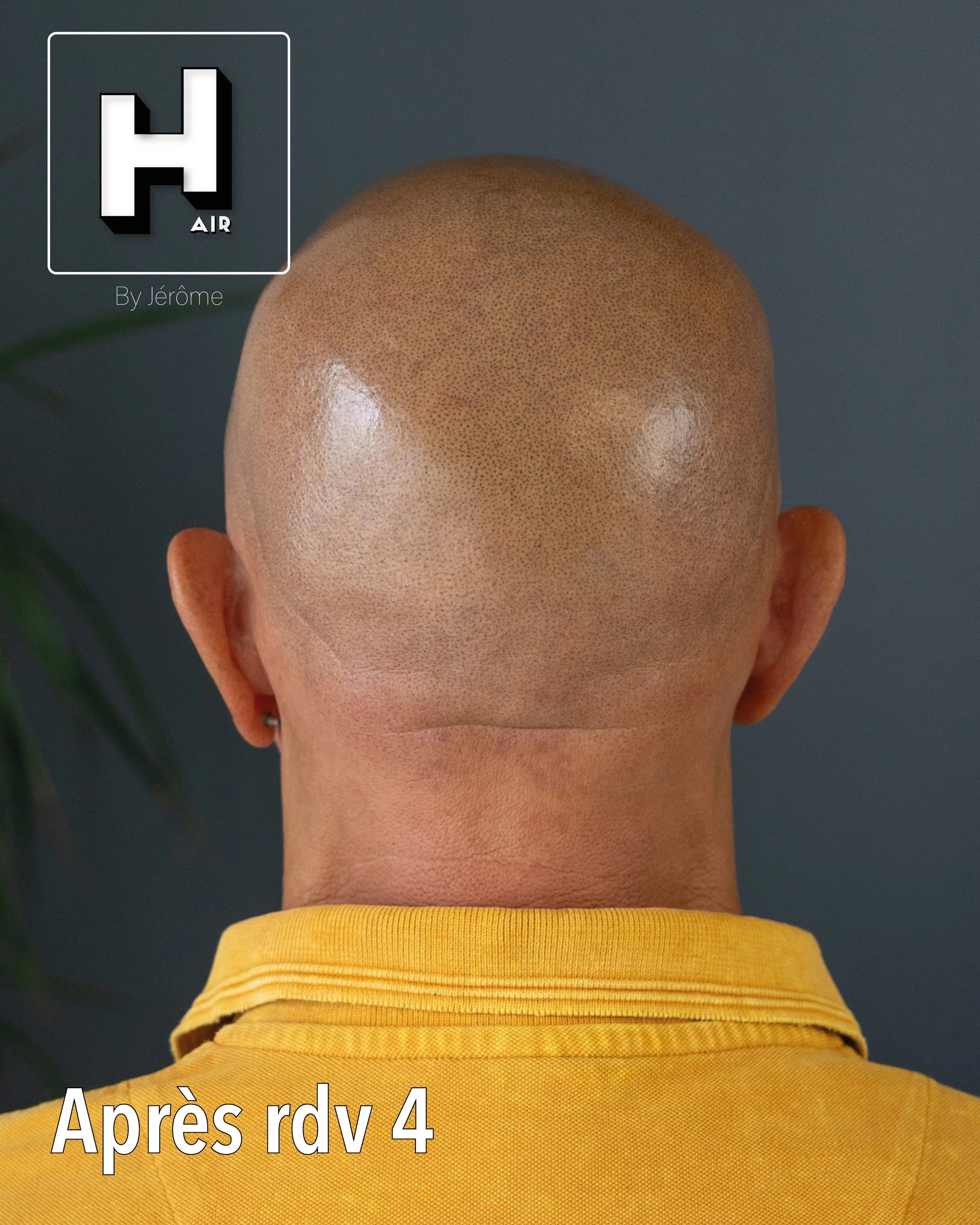 evolution alopecie universelle23.jpg